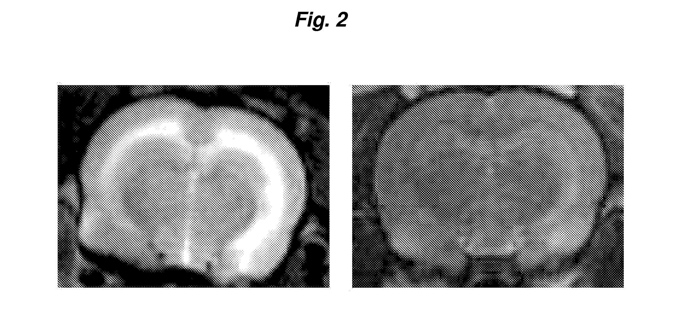 Method for reducing intracranial pressure