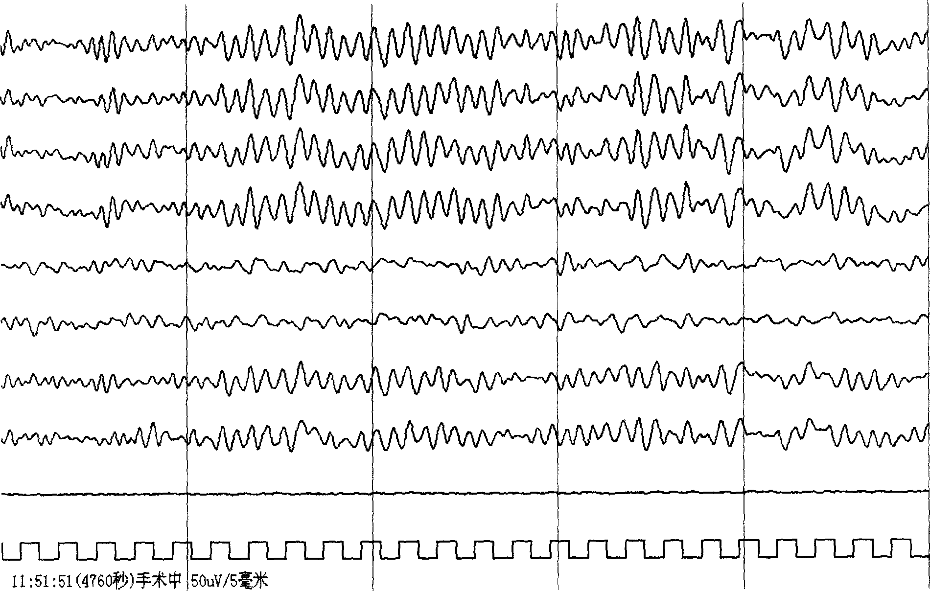 Method for generating electrocortical potential nonlinear trend diagram used in real-time monitoring