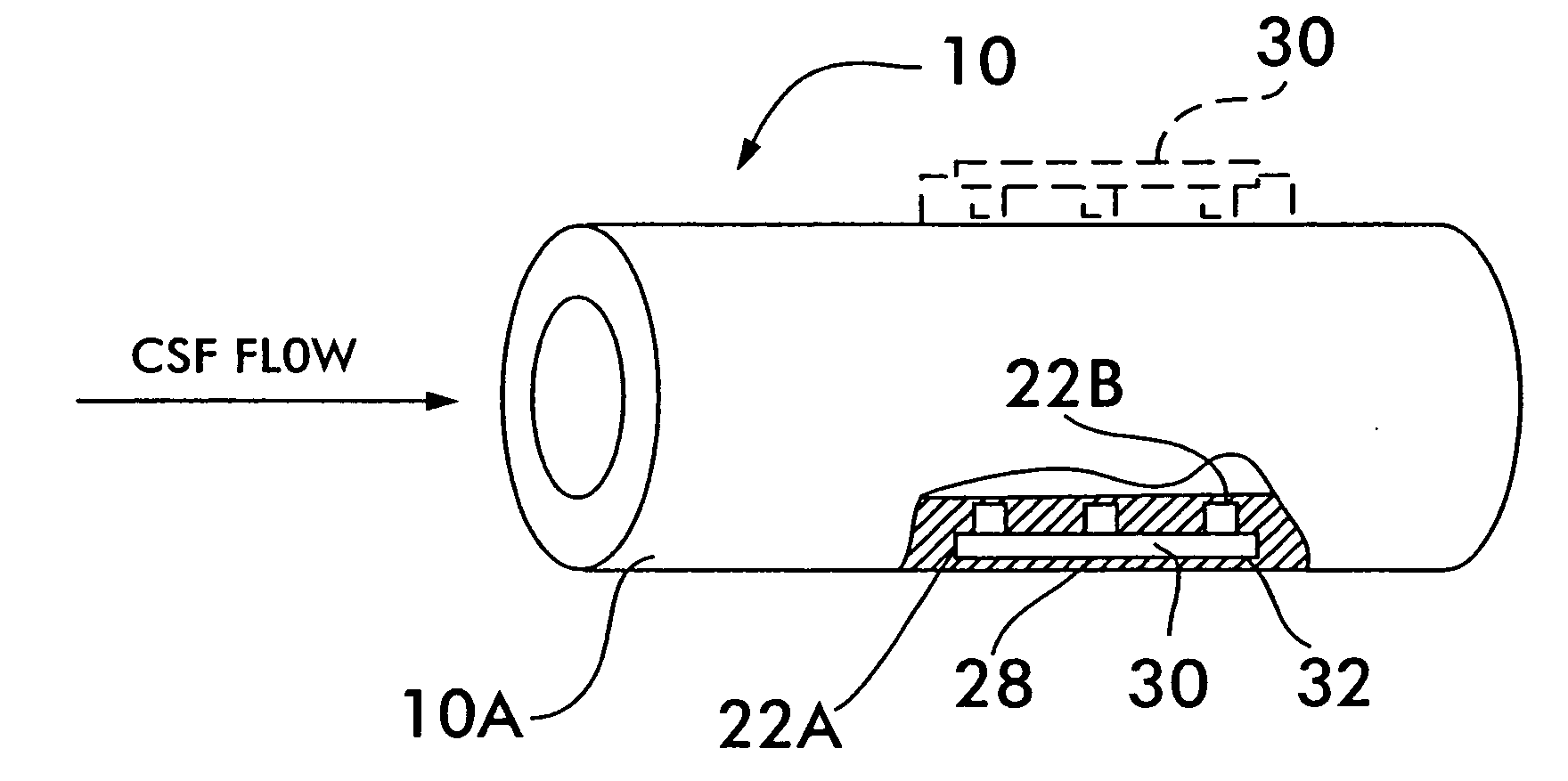 System and method for measuring flow in implanted cerebrospinal fluid shunts