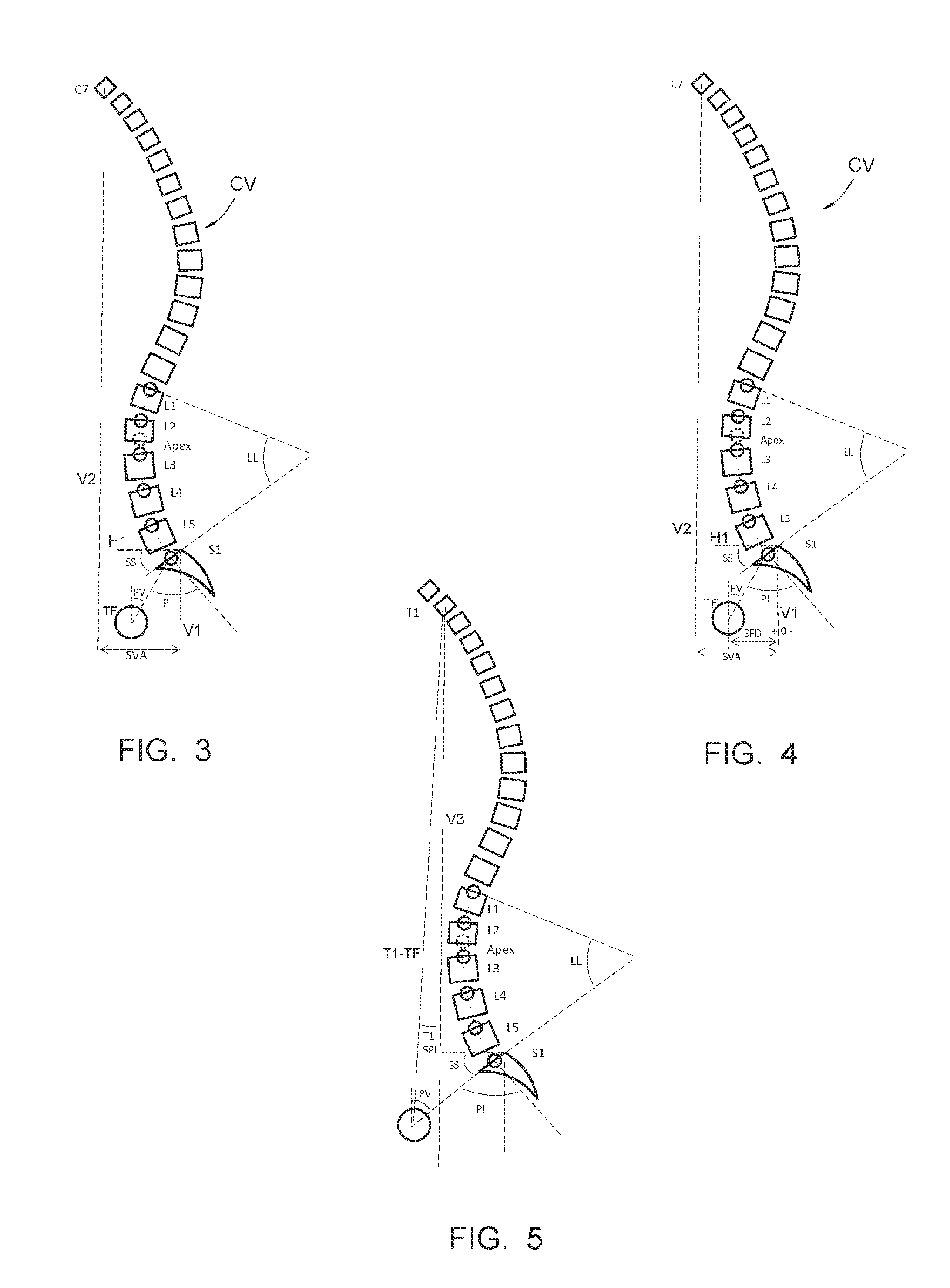 Method making it possible to produce the ideal curvature of a rod of vertebral osteosynthesis material designed to support a patient's vertebral column