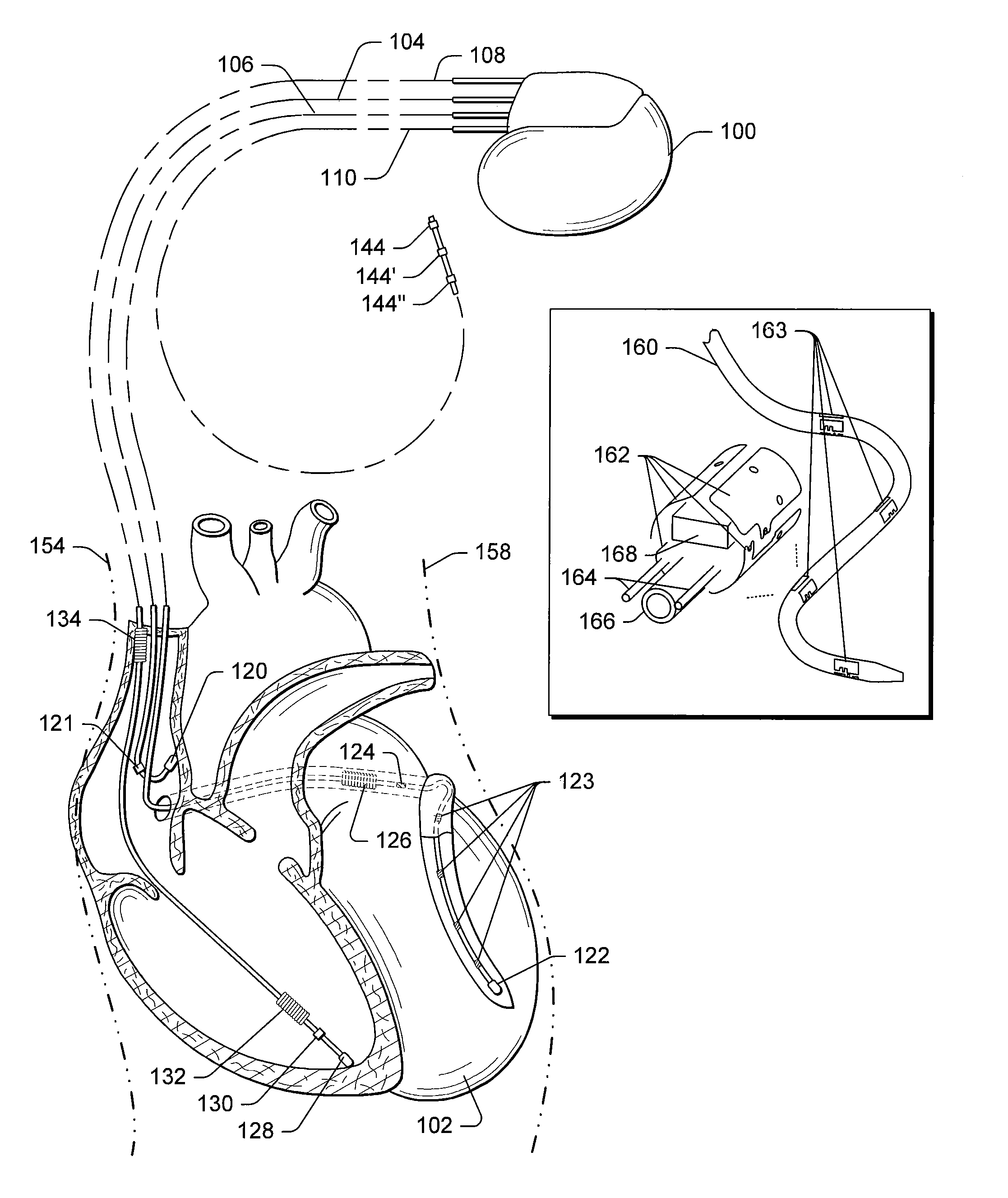 Cardiac Resynchronization Therapy Optimization Using Vector Measurements Obtained From Realtime Electrode Position Tracking