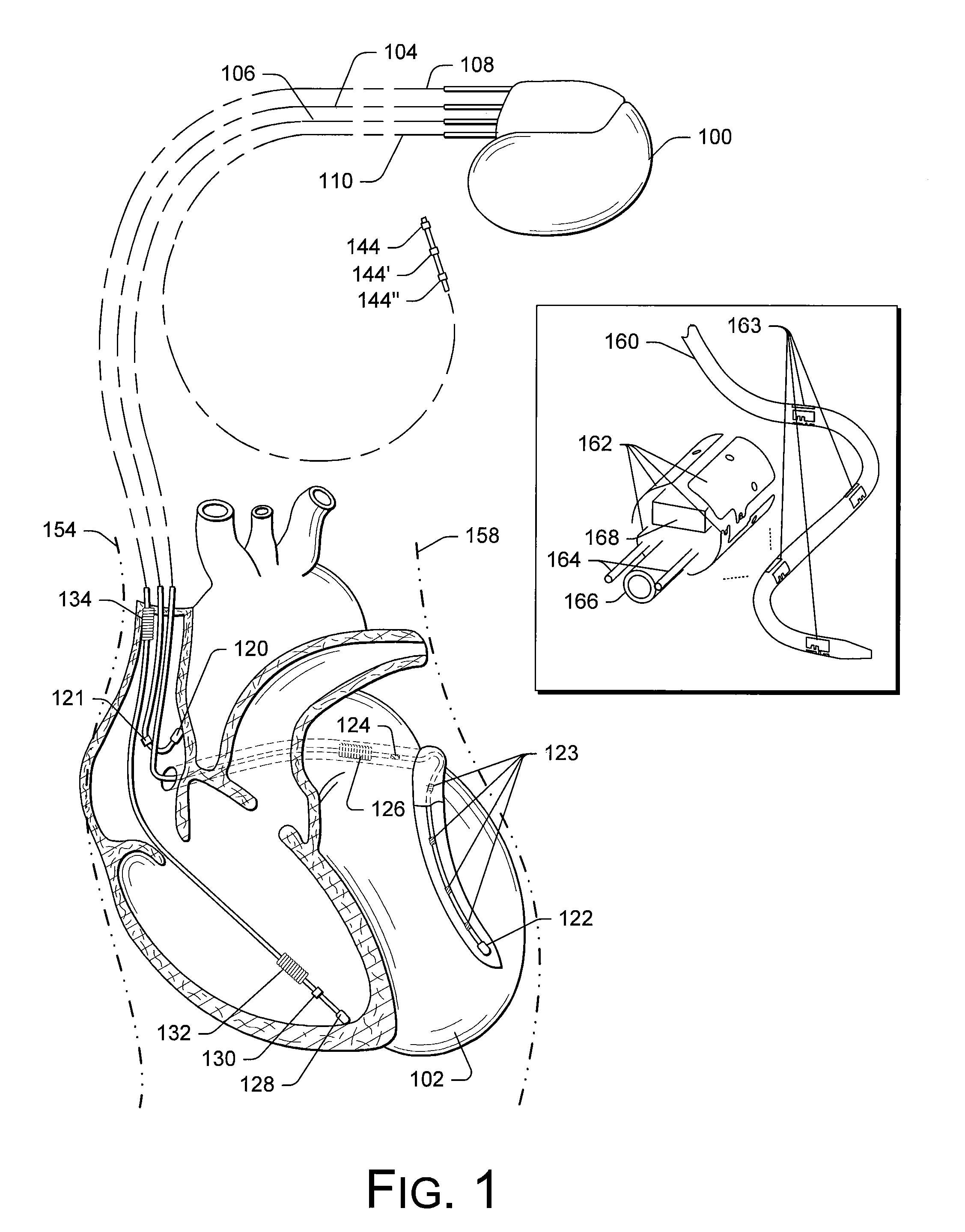 Cardiac Resynchronization Therapy Optimization Using Vector Measurements Obtained From Realtime Electrode Position Tracking