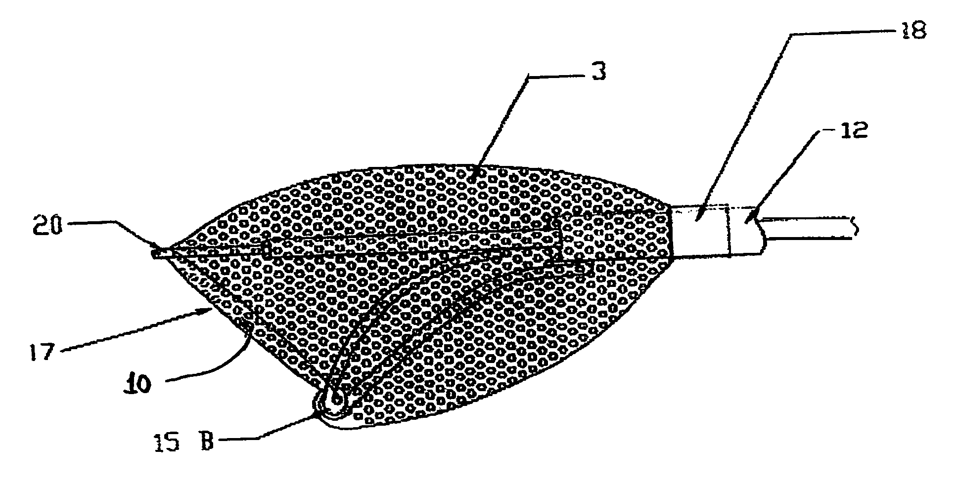 Arterial embolic filter deployed from catheter