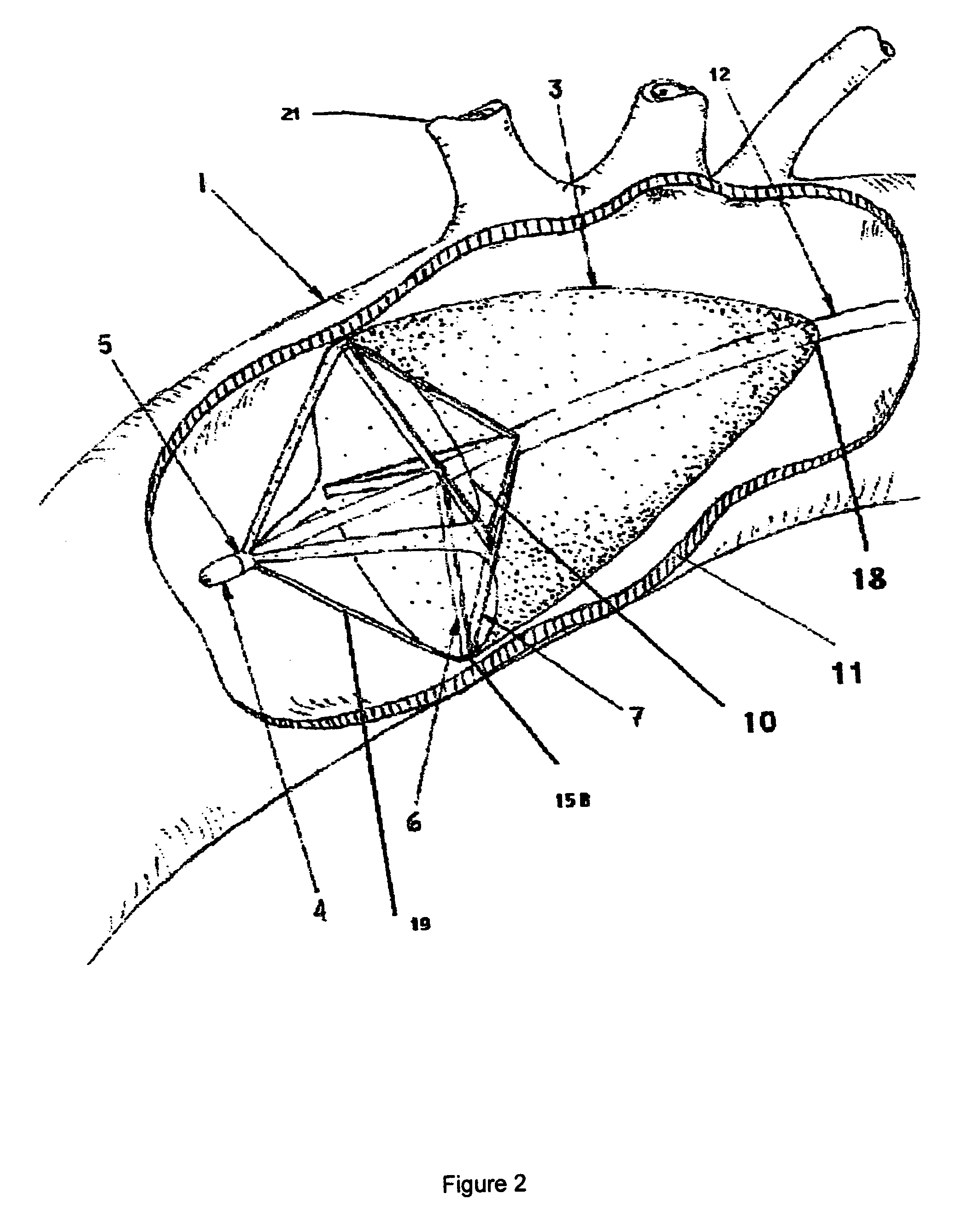 Arterial embolic filter deployed from catheter