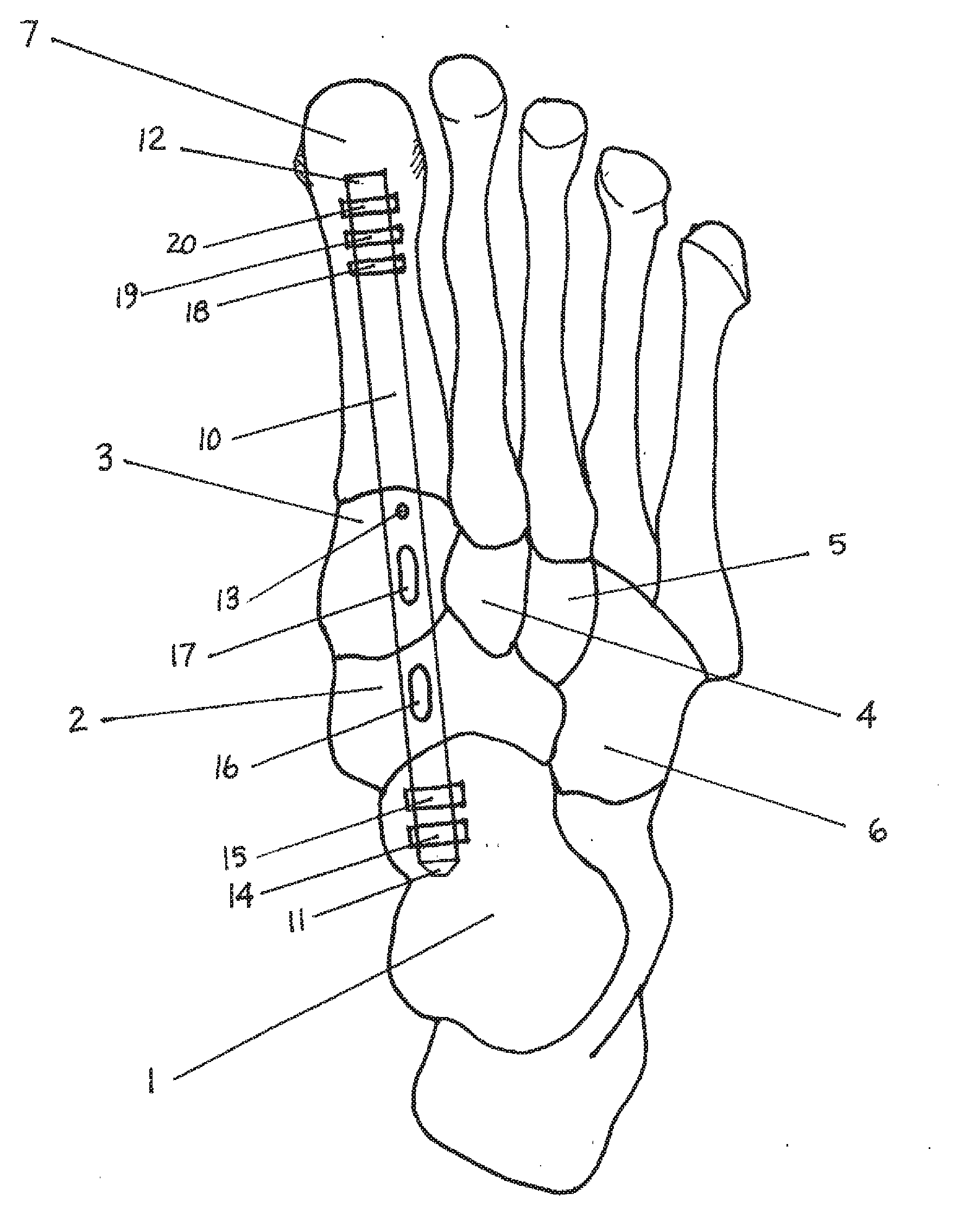 Method and Apparatus for Repairing the Mid-Foot Region Via an Intramedullary Nail