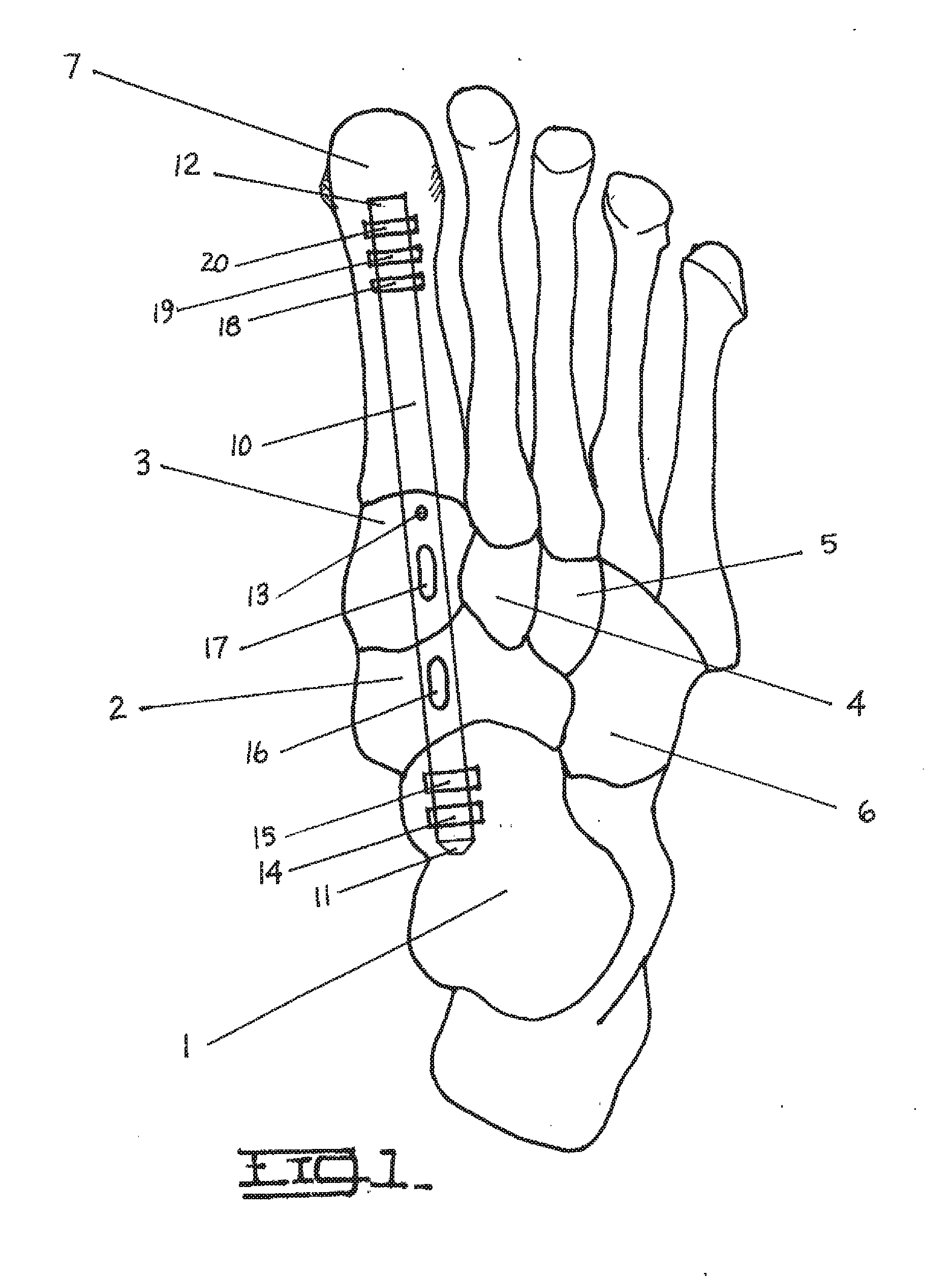 Method and Apparatus for Repairing the Mid-Foot Region Via an Intramedullary Nail