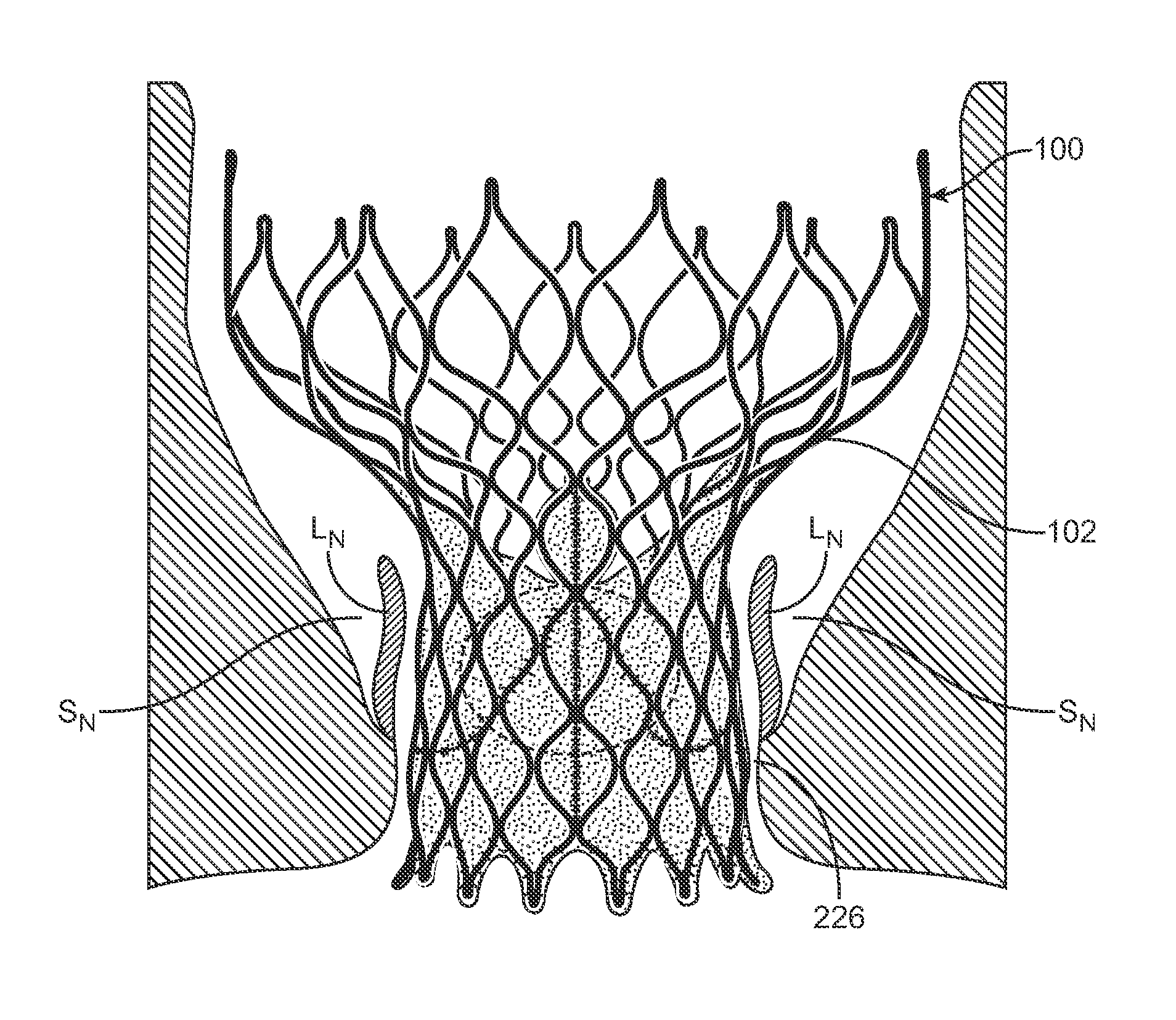 Anti-Paravalvular Leakage Component for a Transcatheter Valve Prosthesis