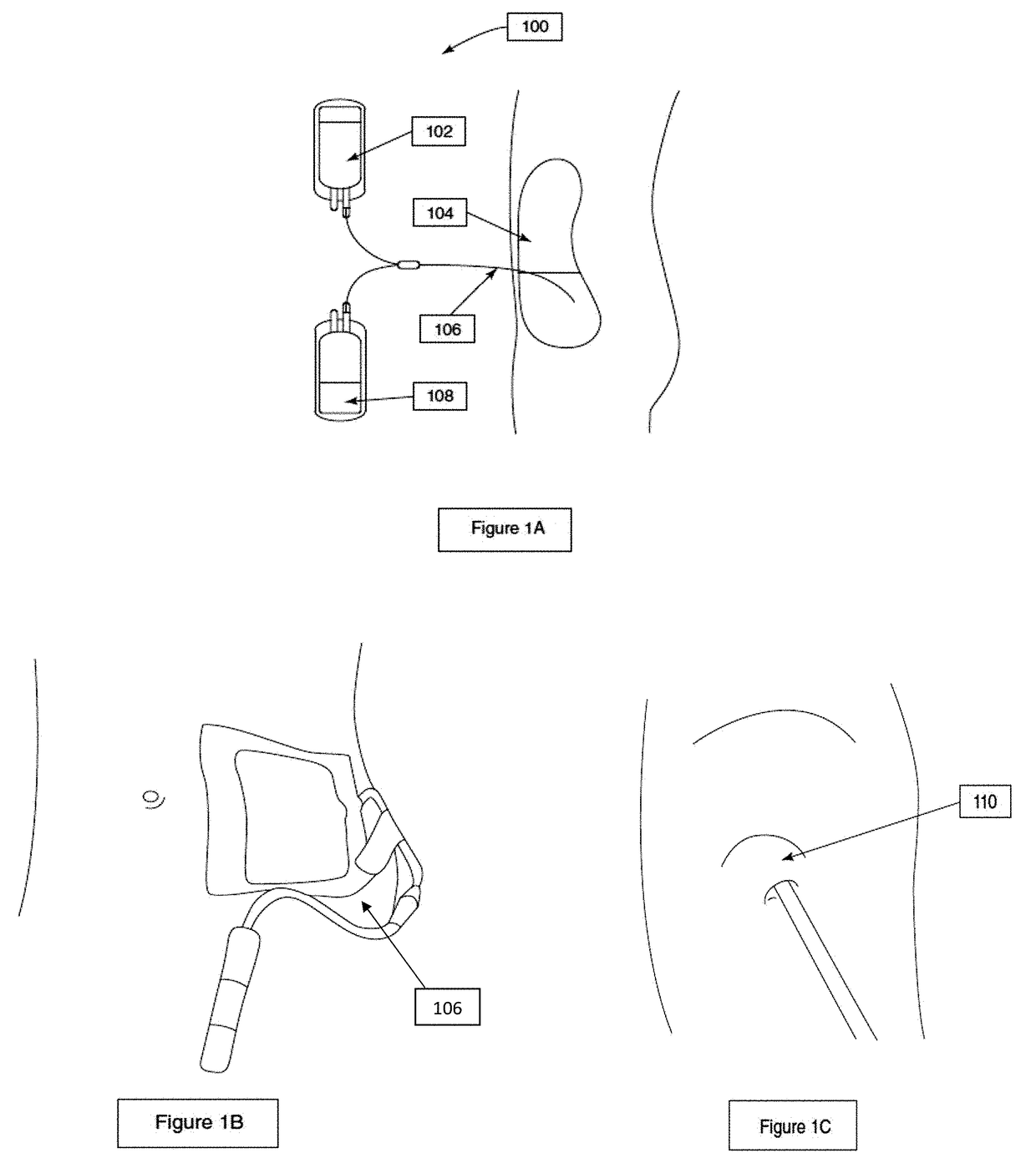 Medicated Patch for Preventing Exit Site Infections during Peritoneal Dialysis