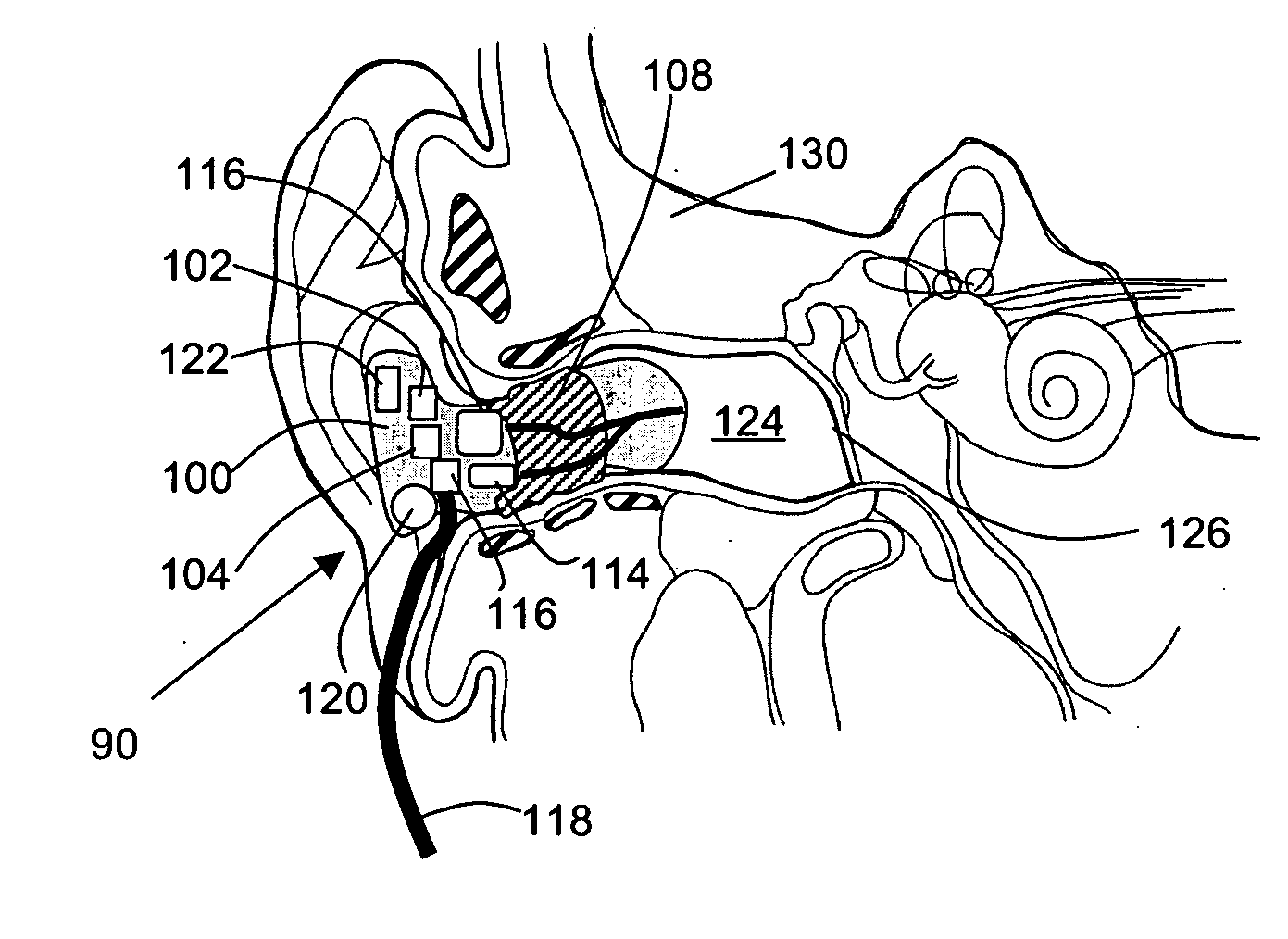 Device and method for remote acoustic porting and magnetic acoustic connection