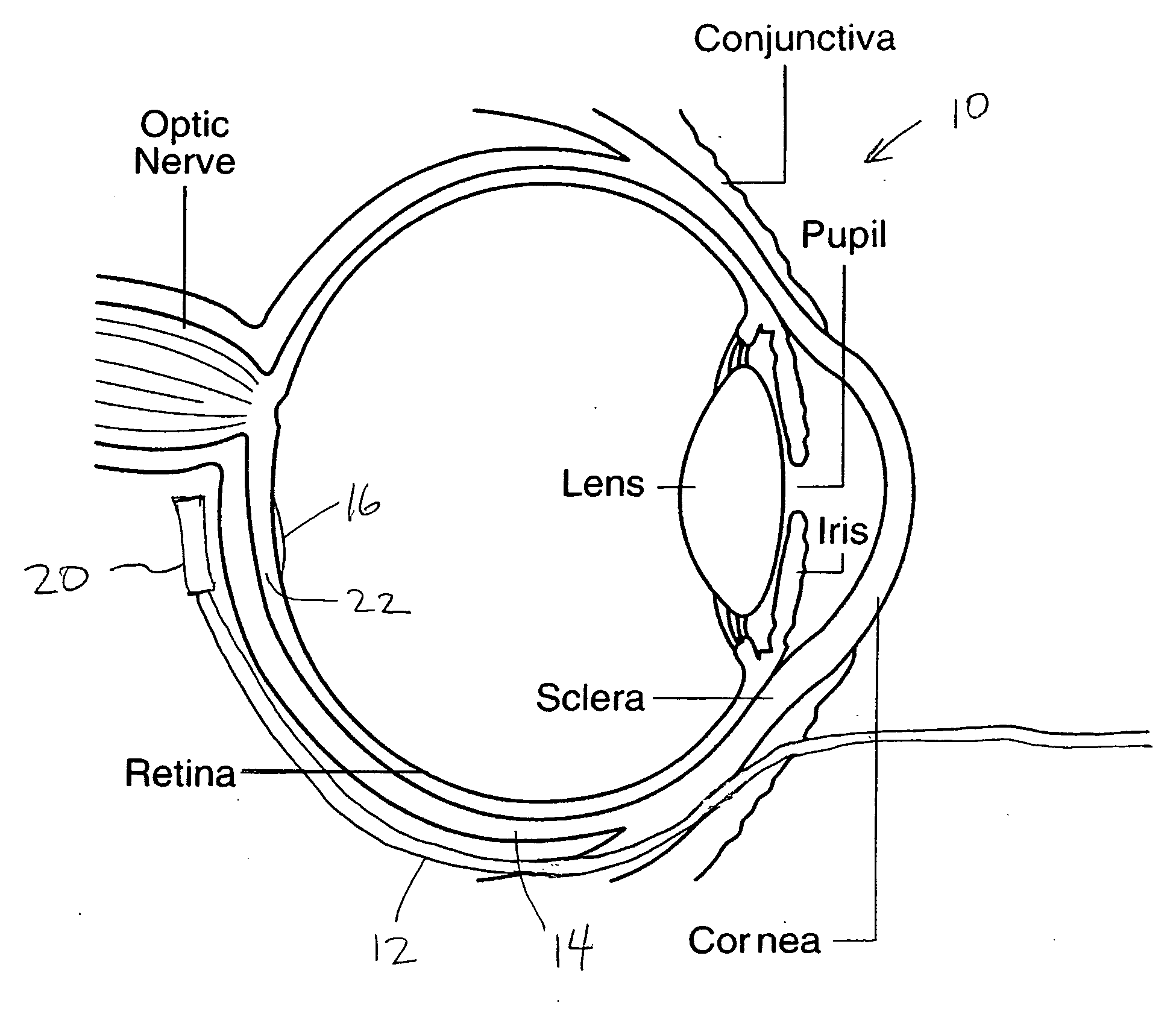 Treatment of age-related macular degeneration