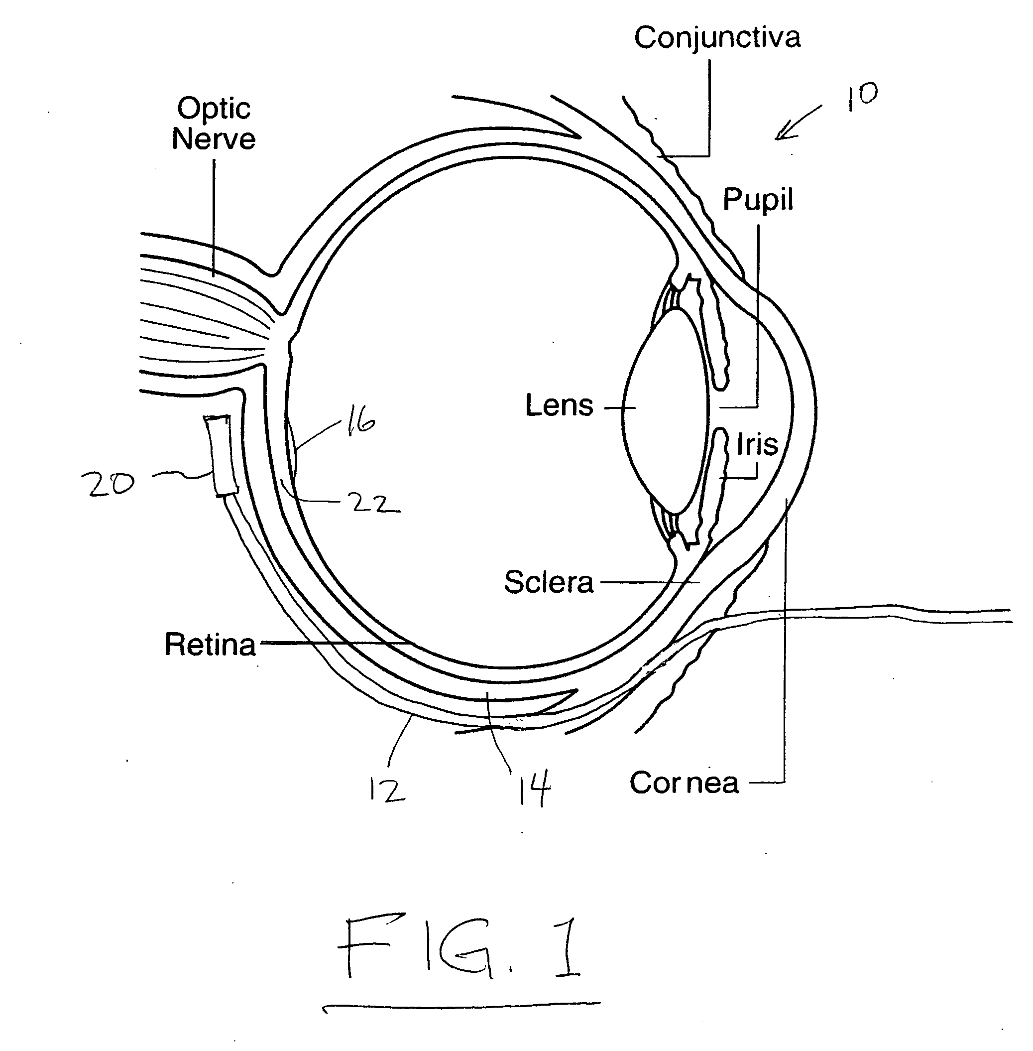 Treatment of age-related macular degeneration