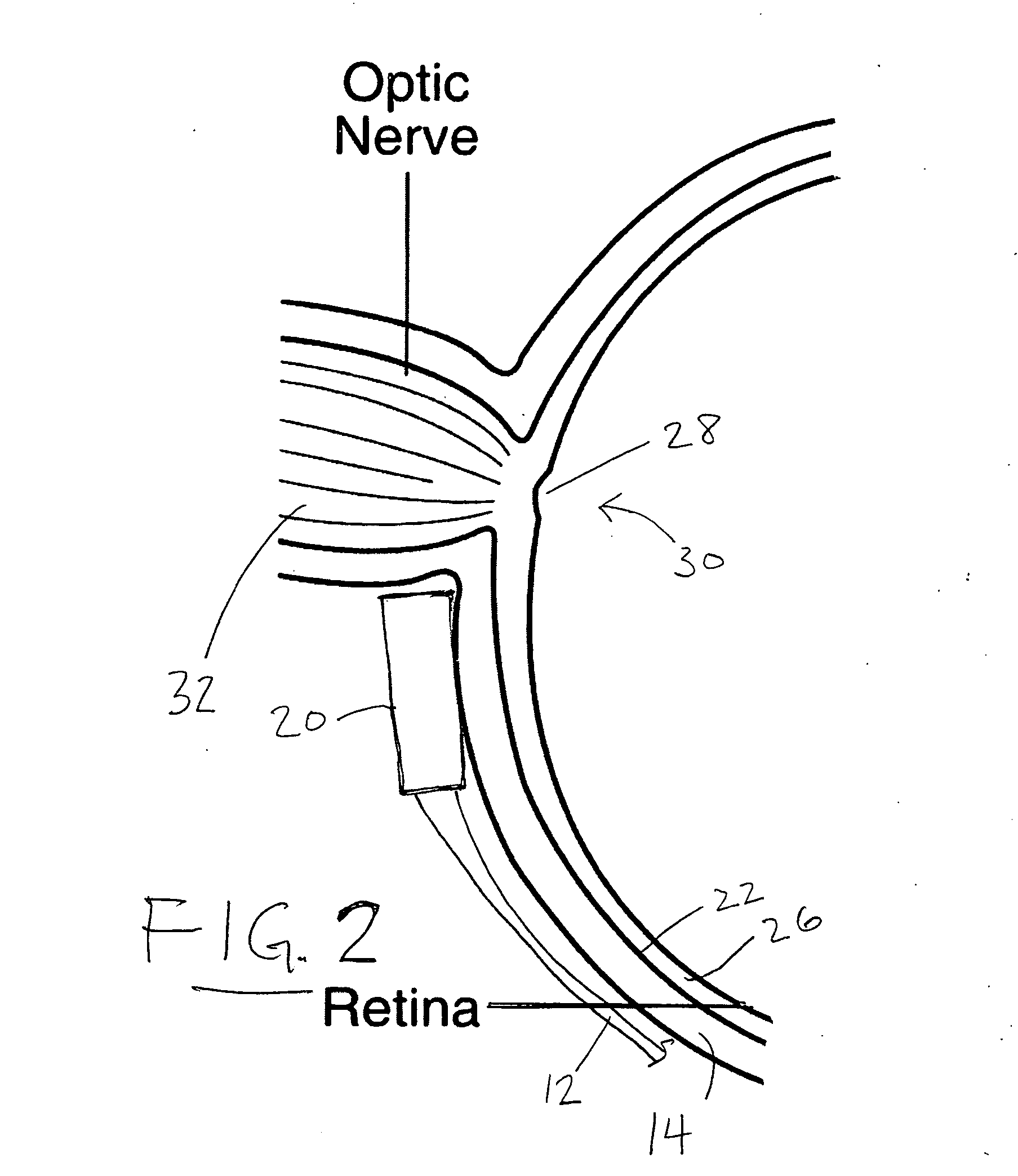 Treatment of age-related macular degeneration