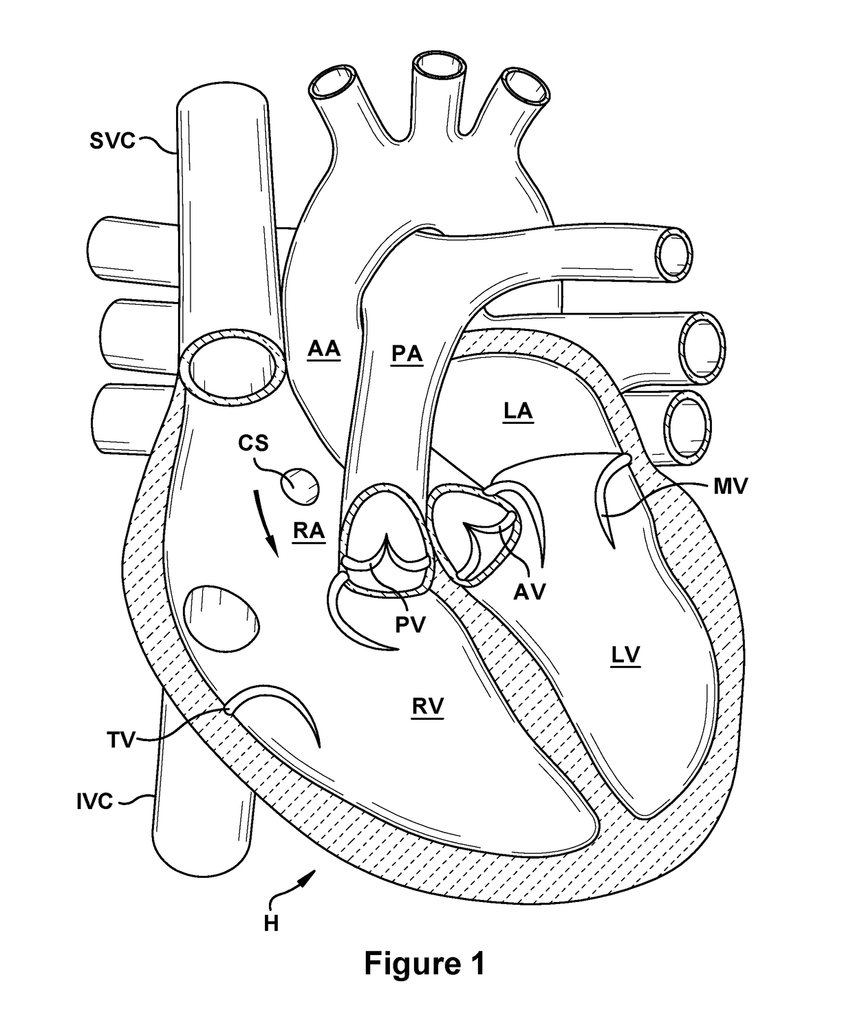 Native valve repair devices and procedures