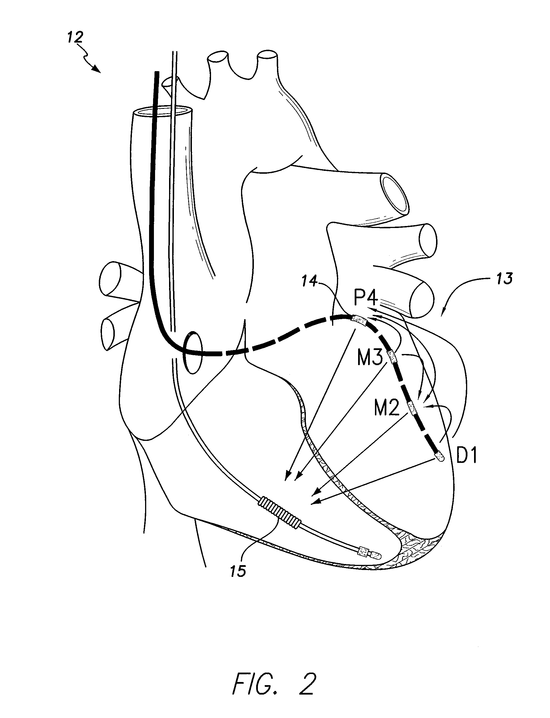 Systems and methods for optimizing ventricular pacing based on left atrial electromechanical activation detected by an AV groove electrode