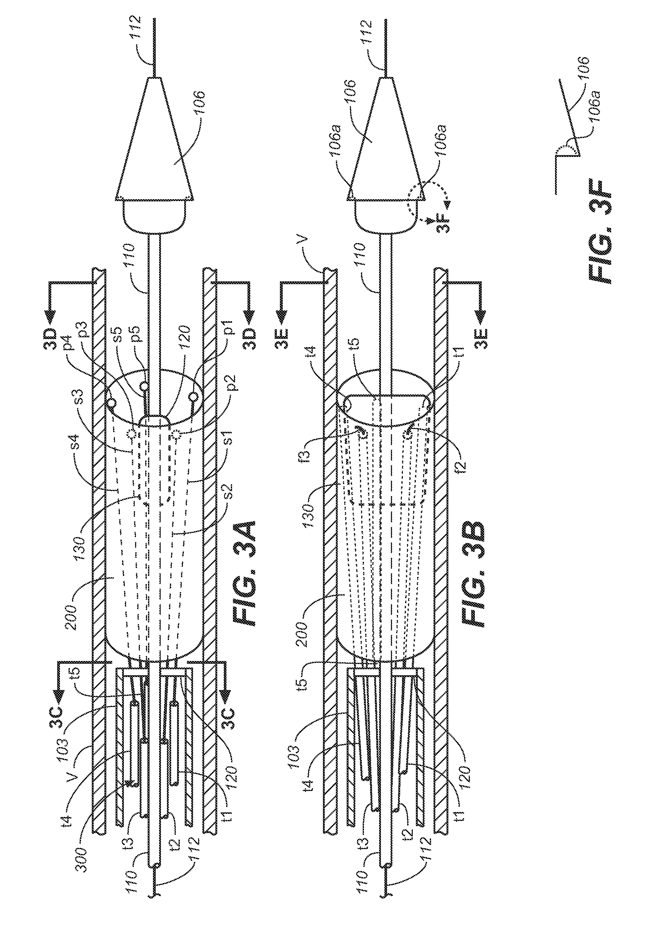 Prosthesis Fixation Apparatus and Methods