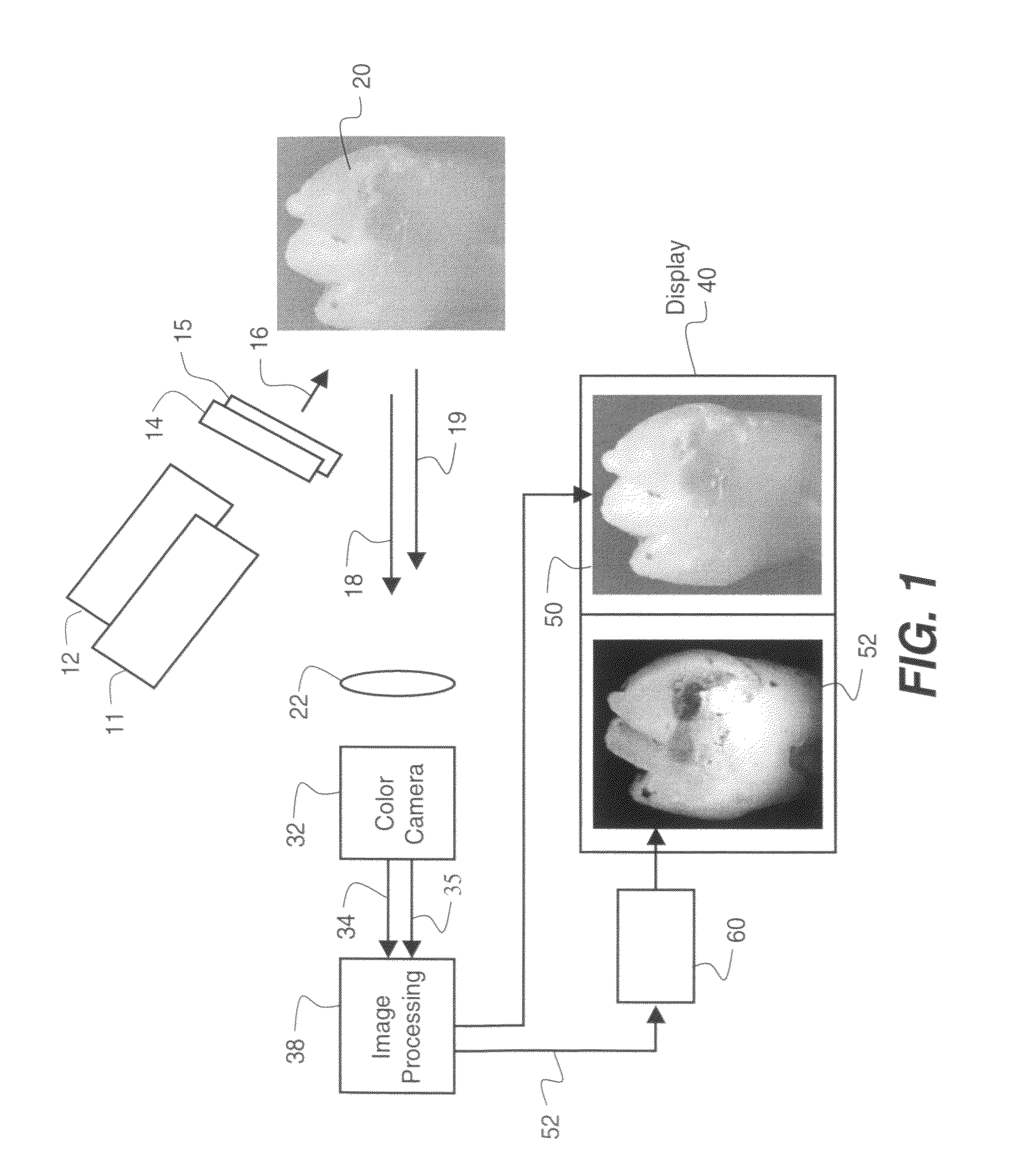 System for early detection of dental caries