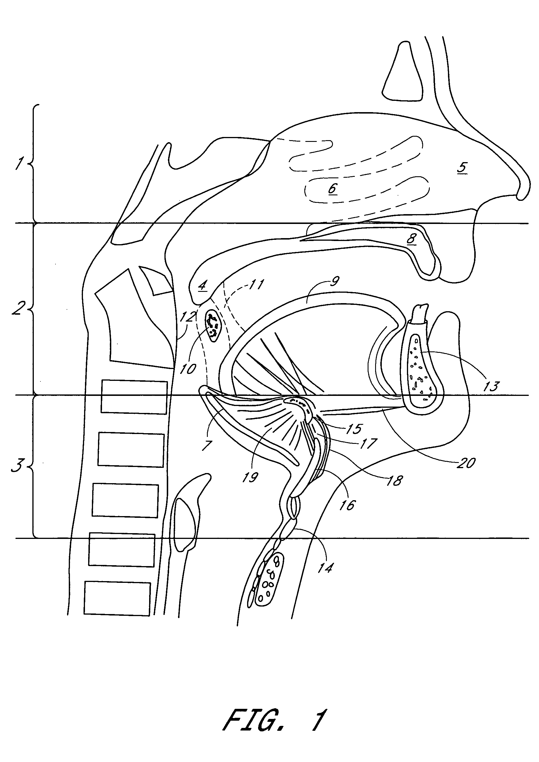 System and method for hyoidplasty