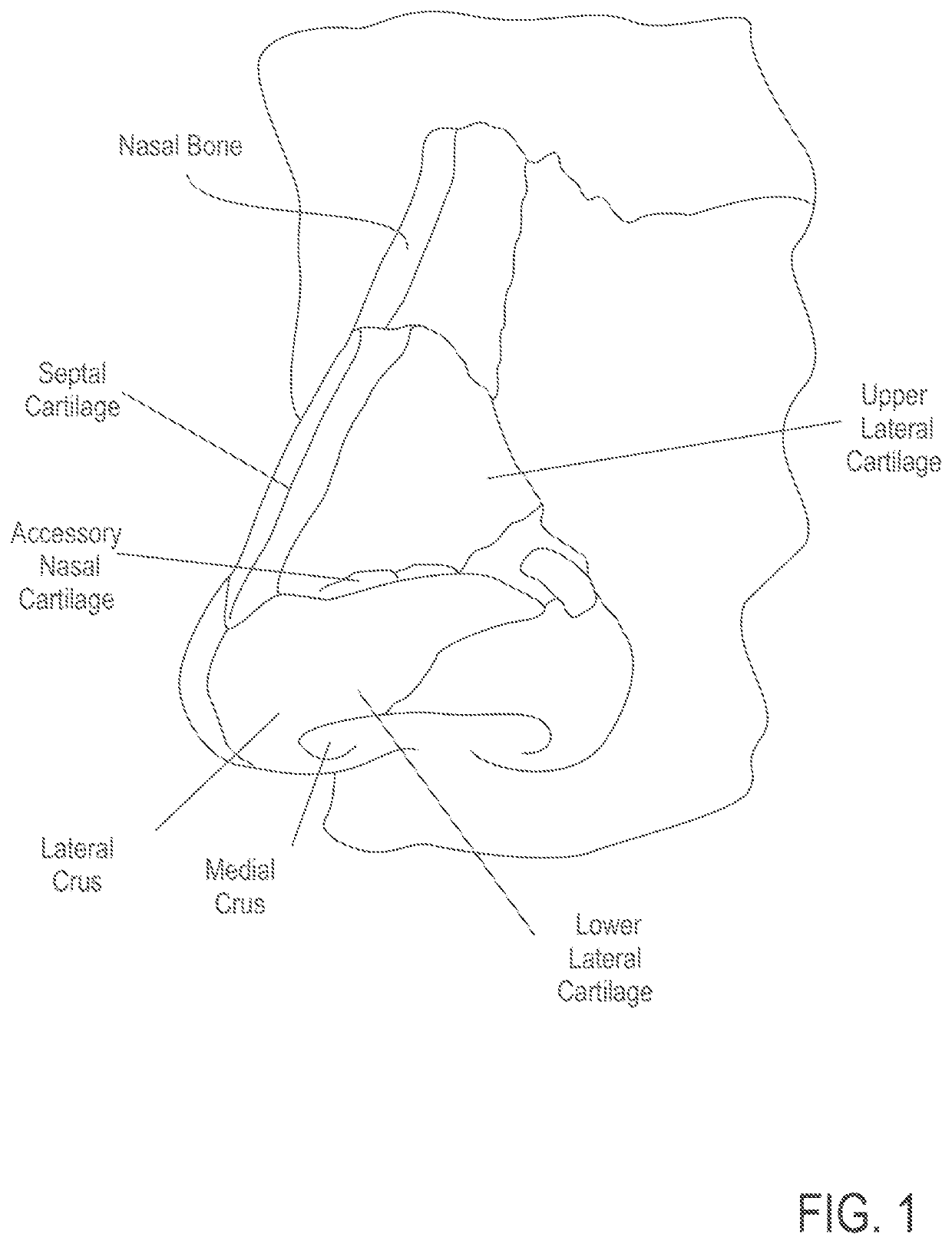 Methods of treating nasal airways