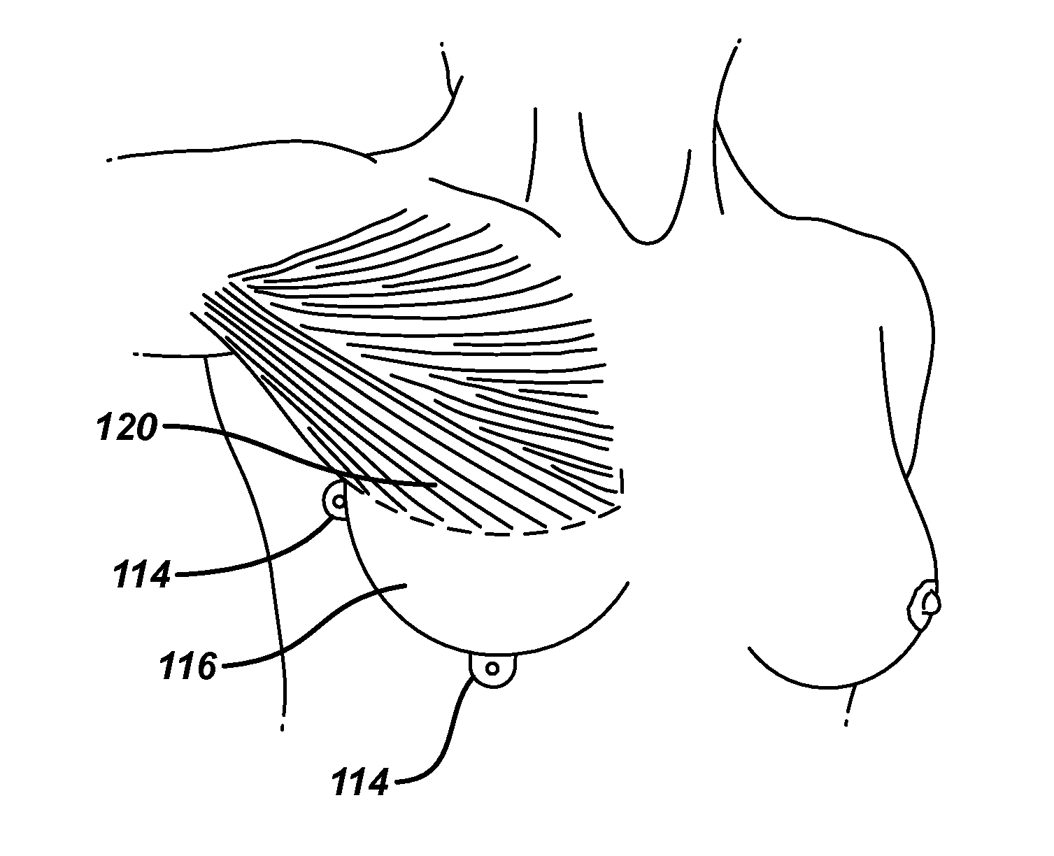 Tissue expander with pectoral attachment