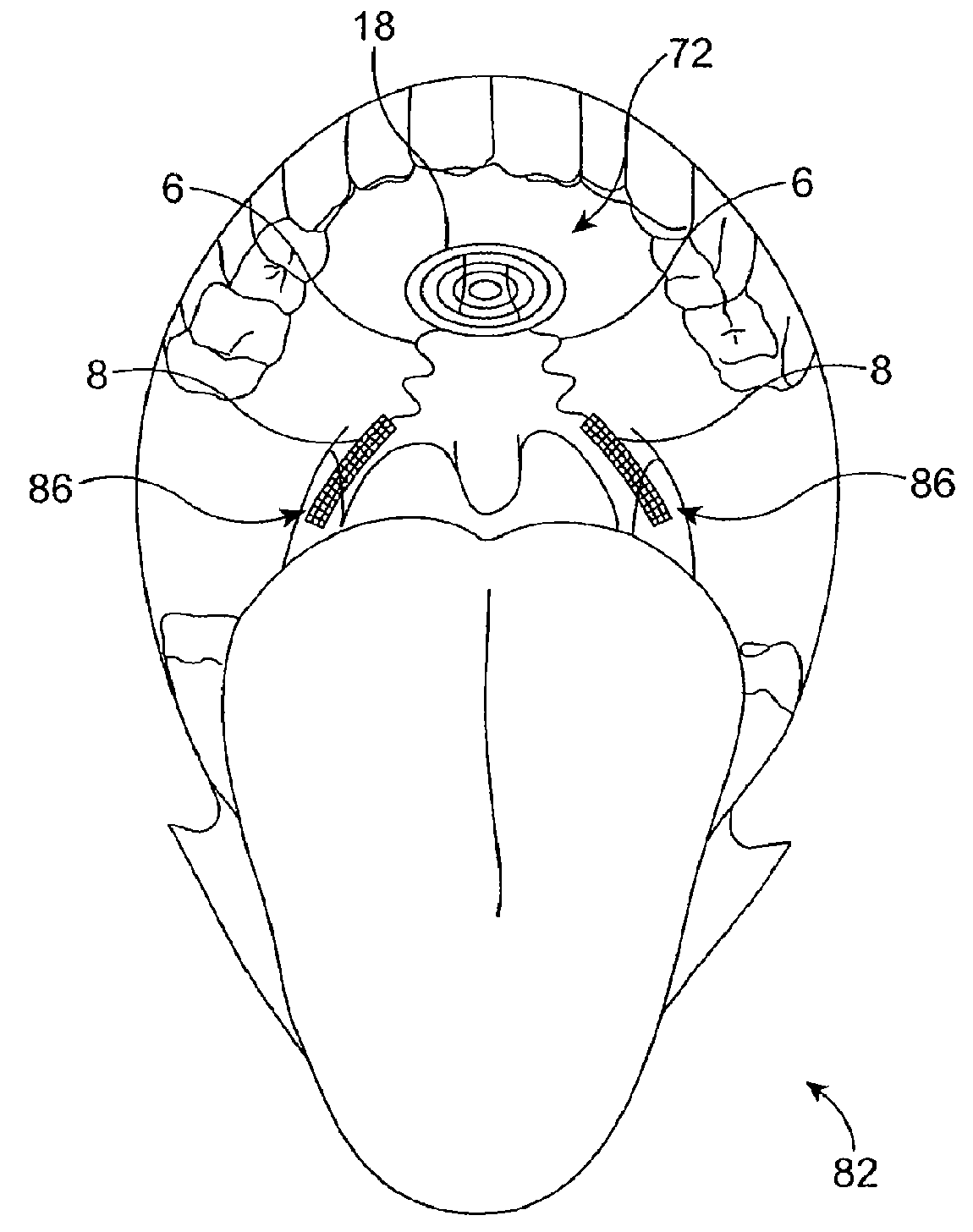 On-off implant for supporting the airway