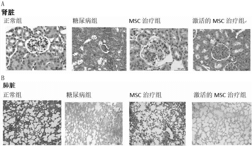 Active mesenchymal stem cell injection for diabetes mellitus infusion