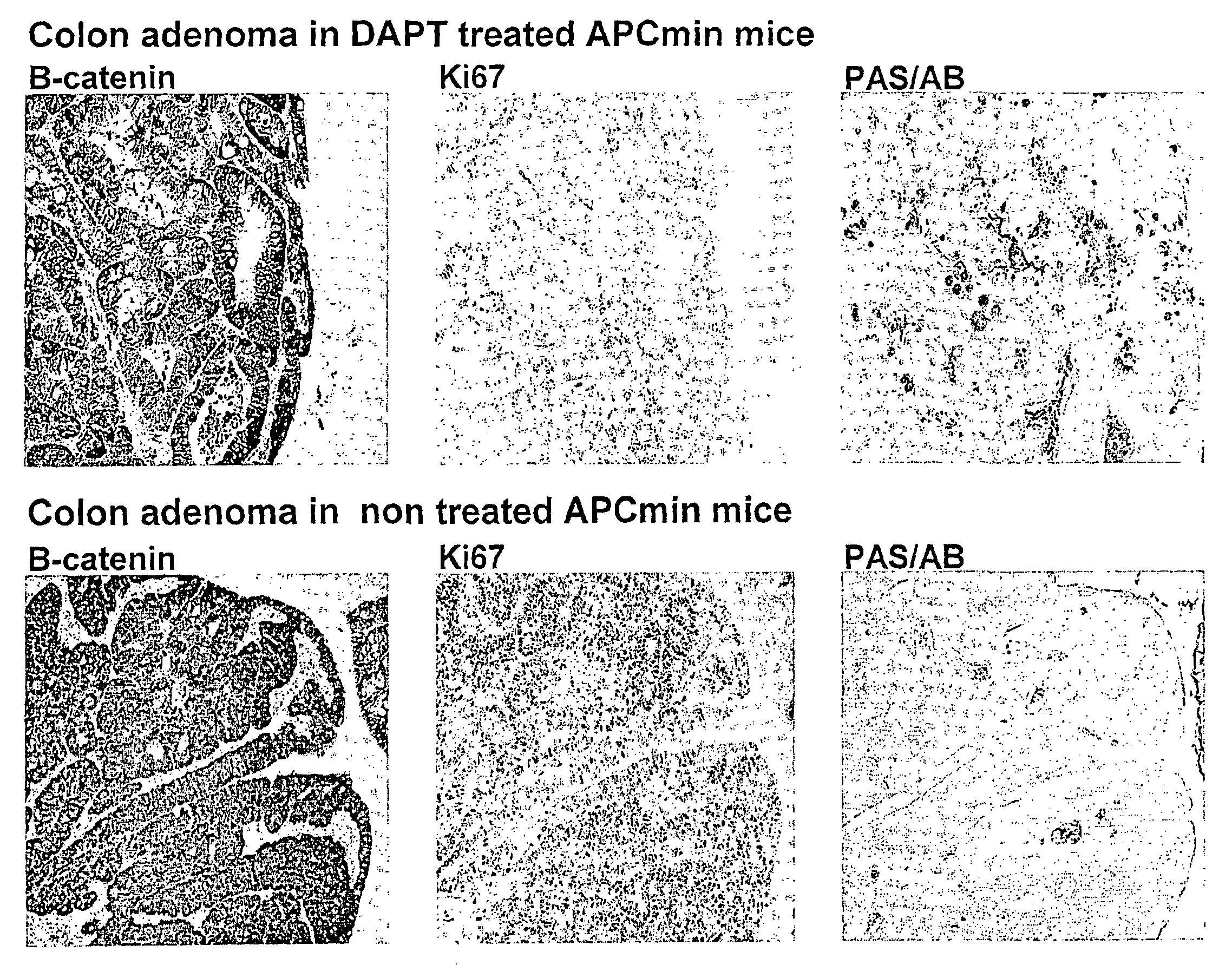 Treatment of an intestinal adenoma and/or adenocarcinoma by inhibition of notch pathway activation