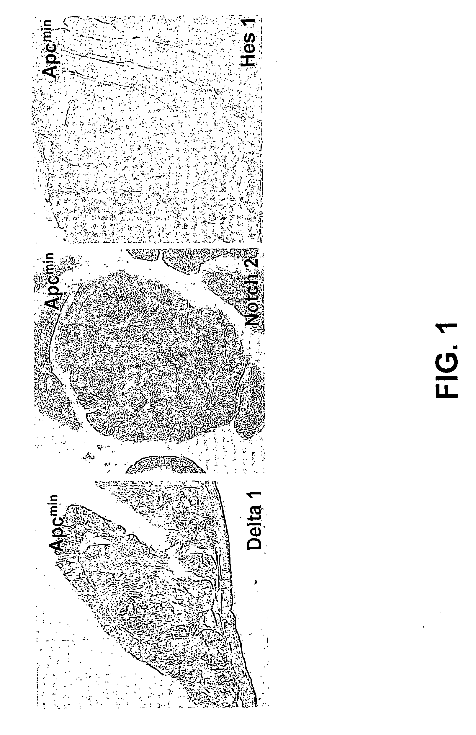 Treatment of an intestinal adenoma and/or adenocarcinoma by inhibition of notch pathway activation