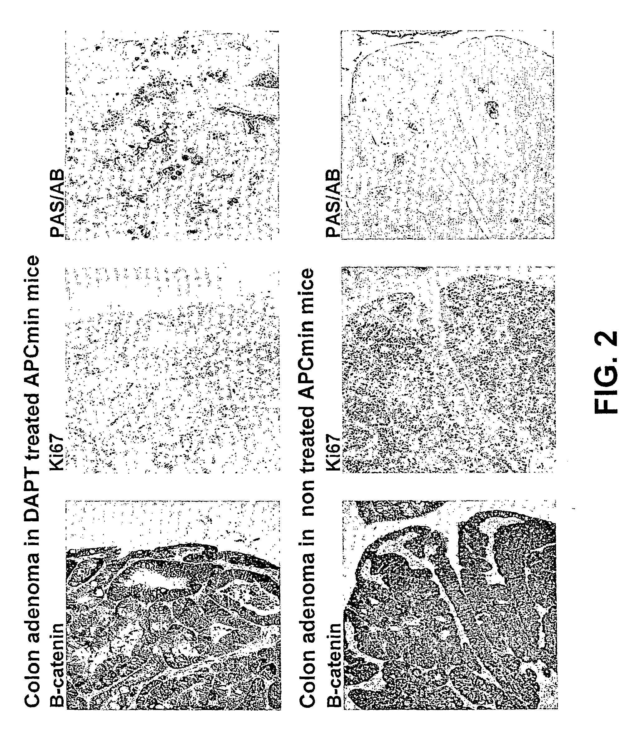 Treatment of an intestinal adenoma and/or adenocarcinoma by inhibition of notch pathway activation