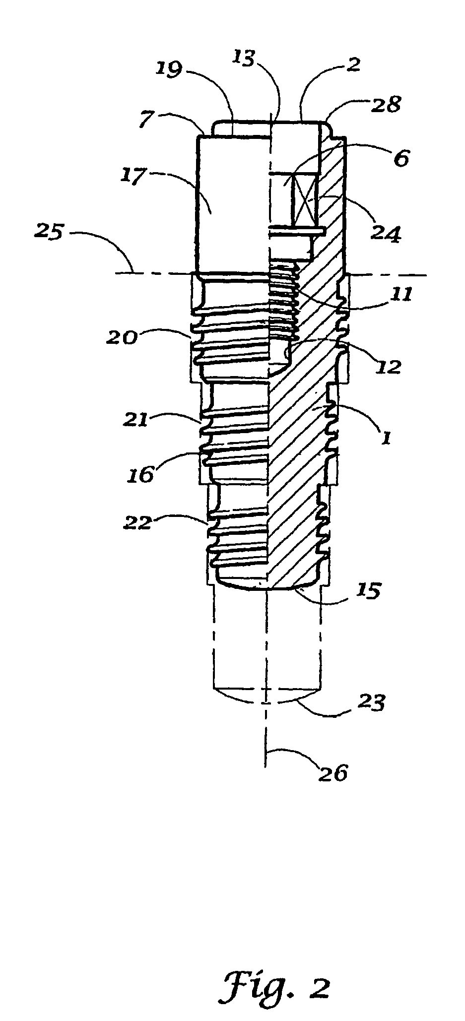 Multi part non metal implant