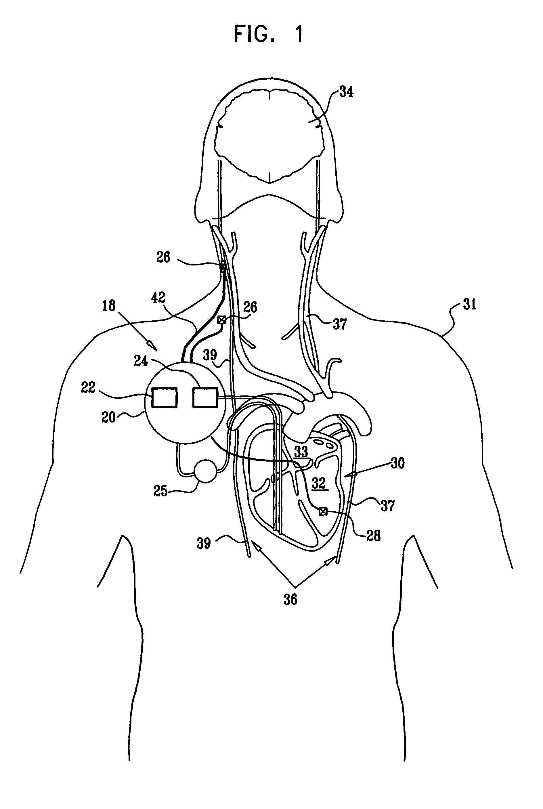 Parasympathetic stimulation for treating ventricular arrhythmia