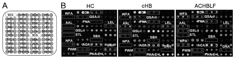 A lectin chip and kit for detecting sugar chain markers based on saliva and co-based on proteins in saliva and serum and its application