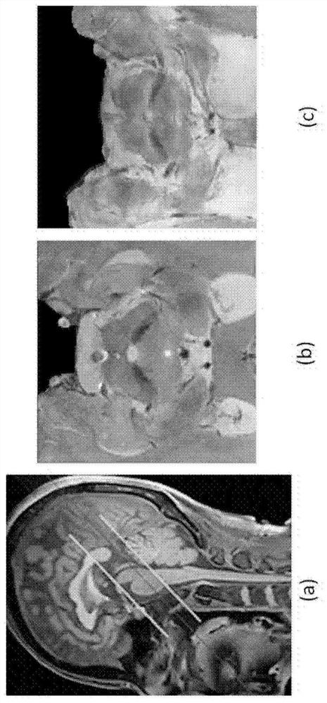 Parkinson's disease diagnosis device and method based on artifical intelligence