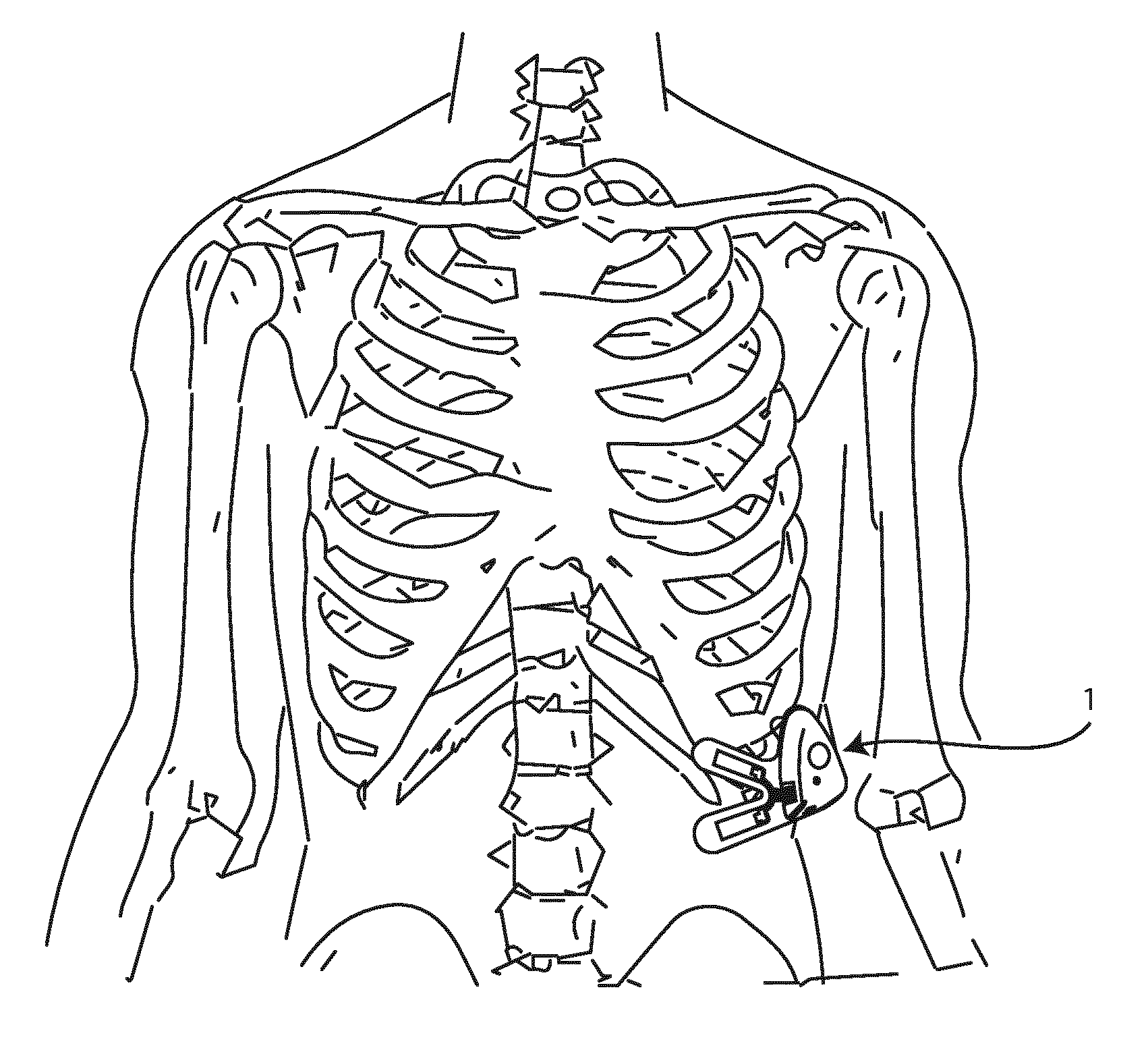 A method and device for respiratory monitoring