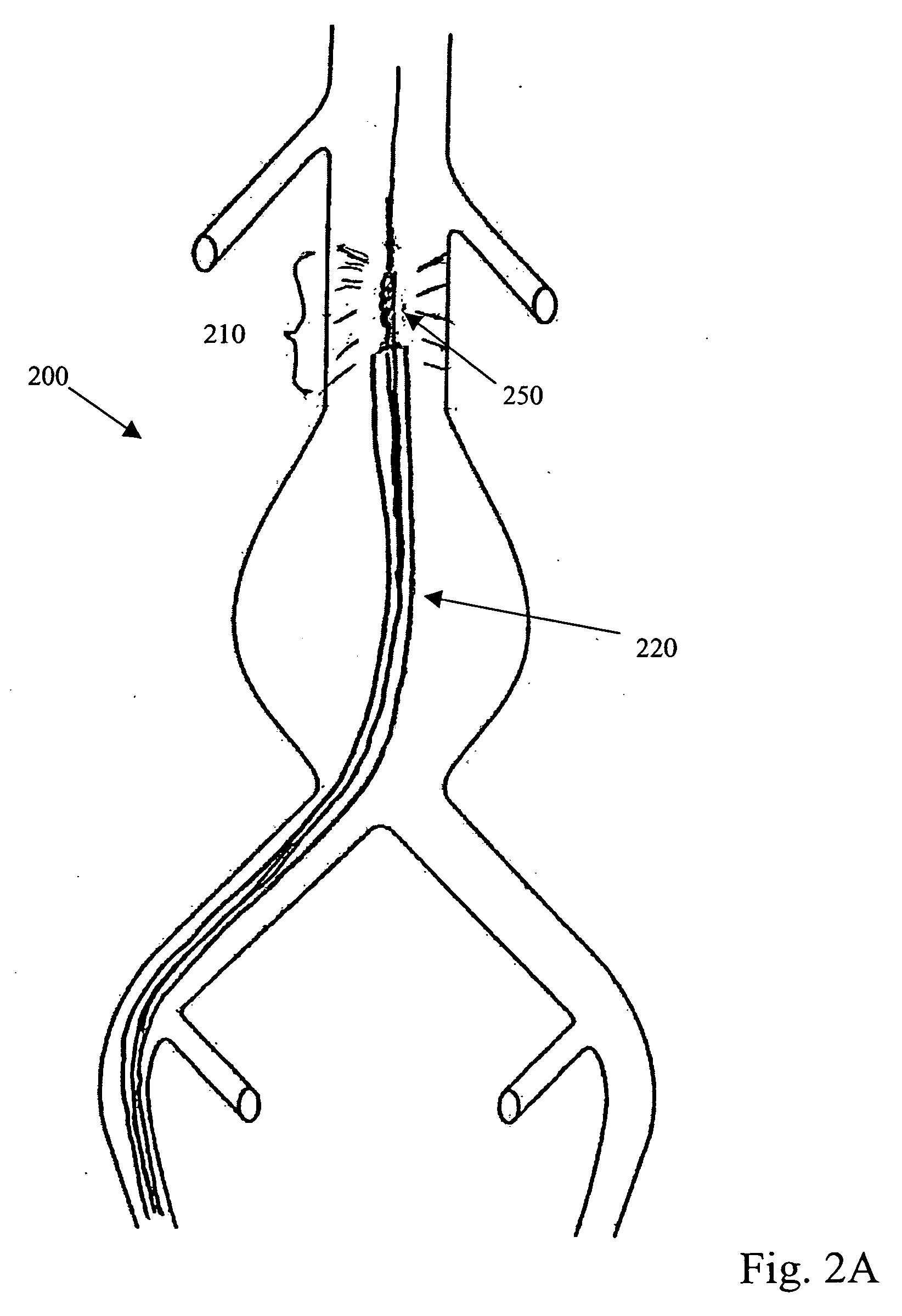 Stabilization of aortic iliac neck diameter by use of radio frequency