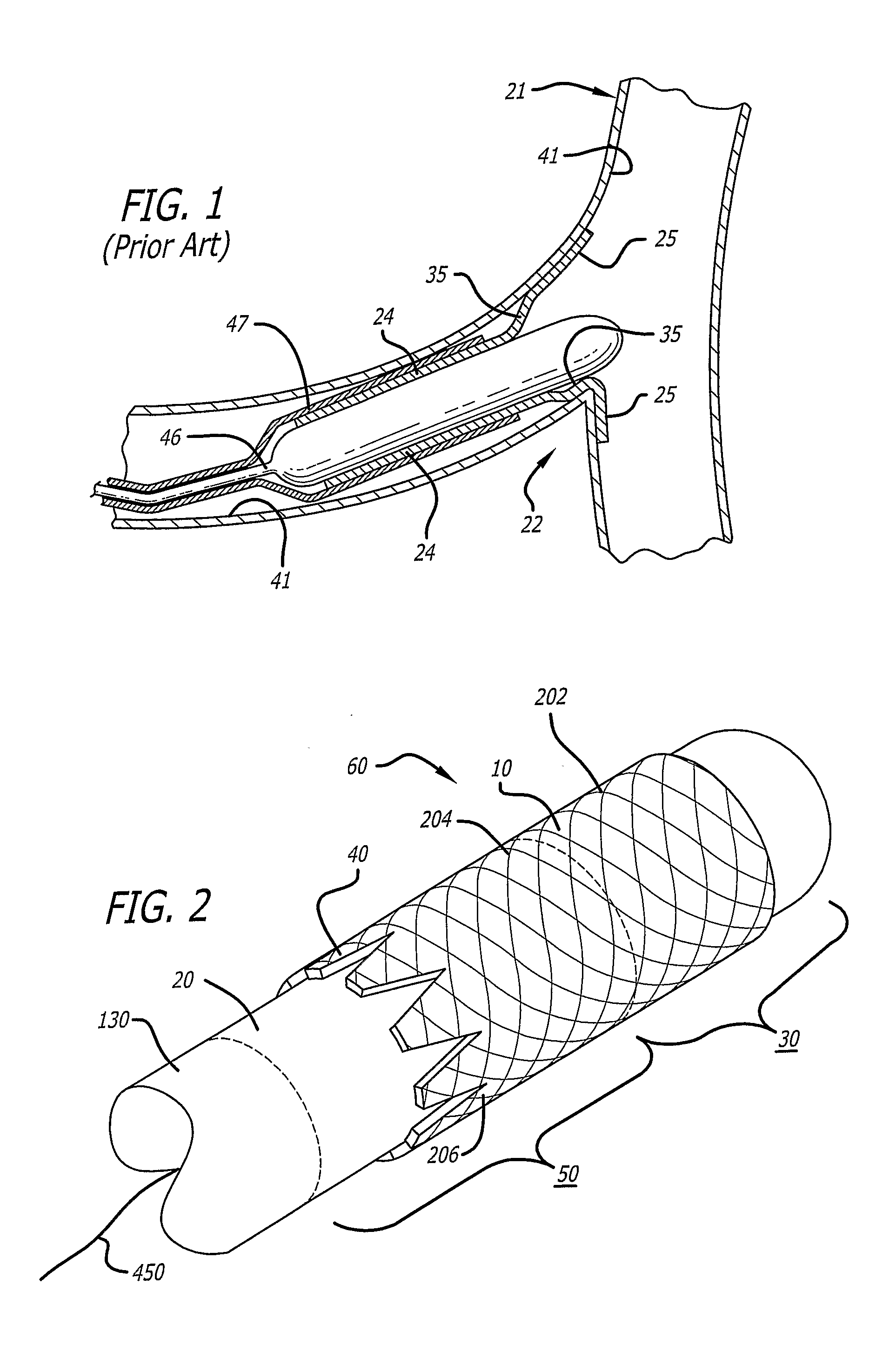 System and method for deploying a proximally-flaring stent