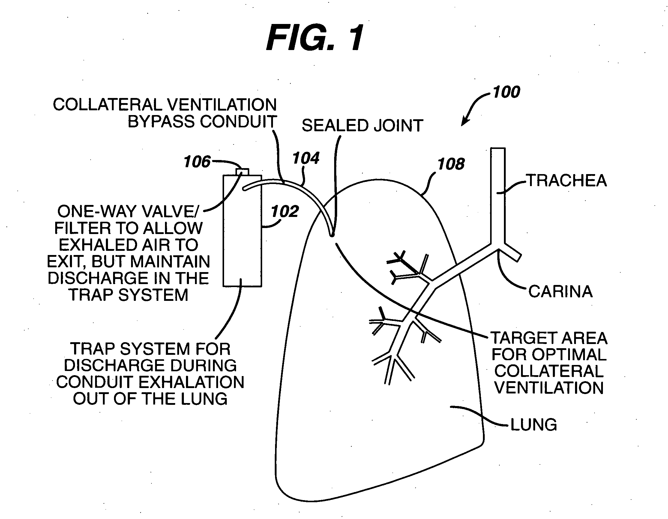 Variable resistance pulmonary ventilation bypass valve