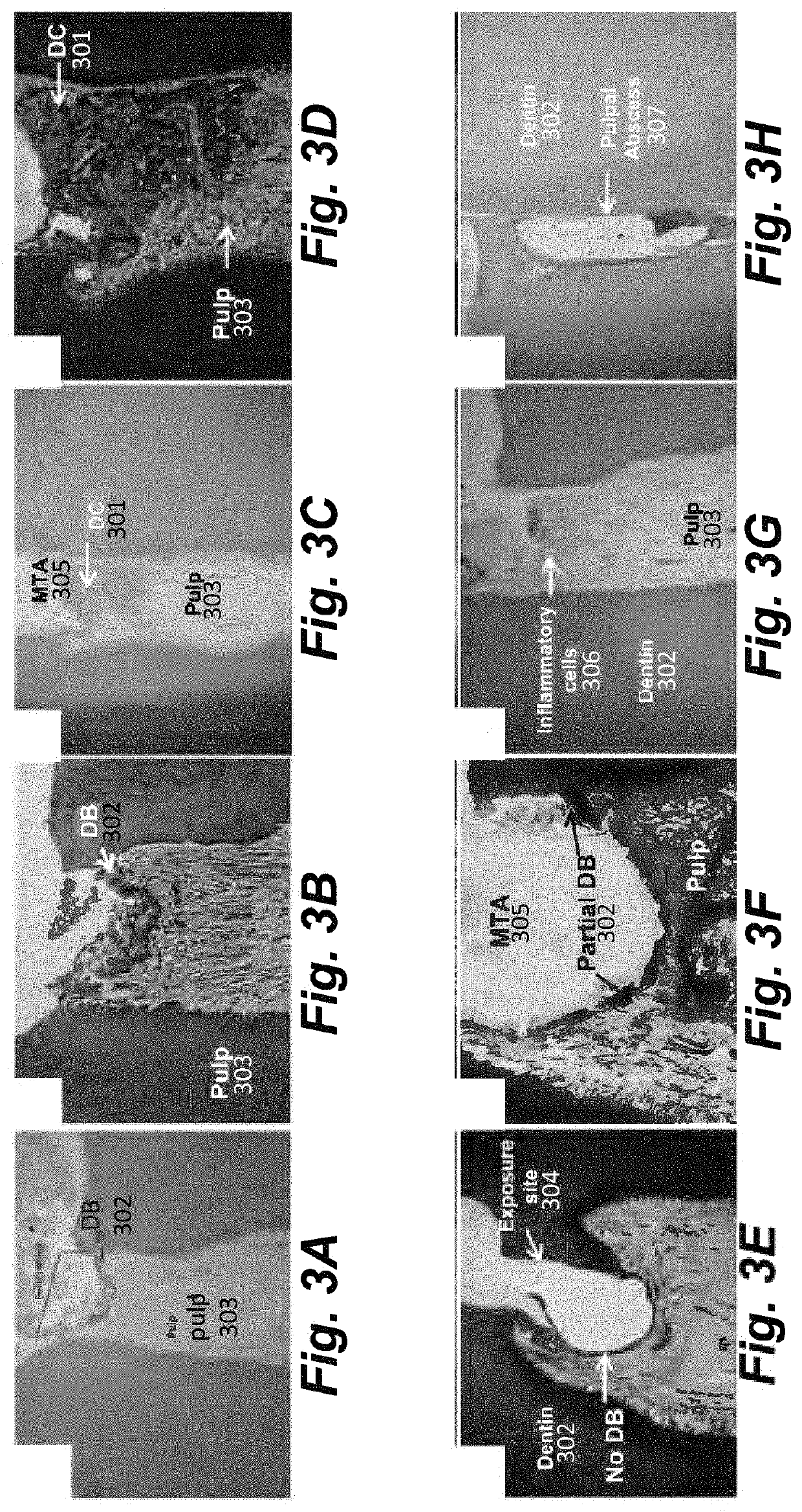 Dental composition and method of direct pulp capping