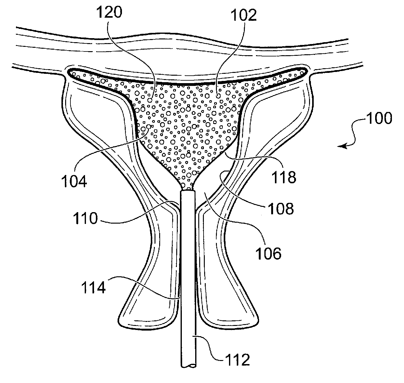 Uterine foam insert for ablation