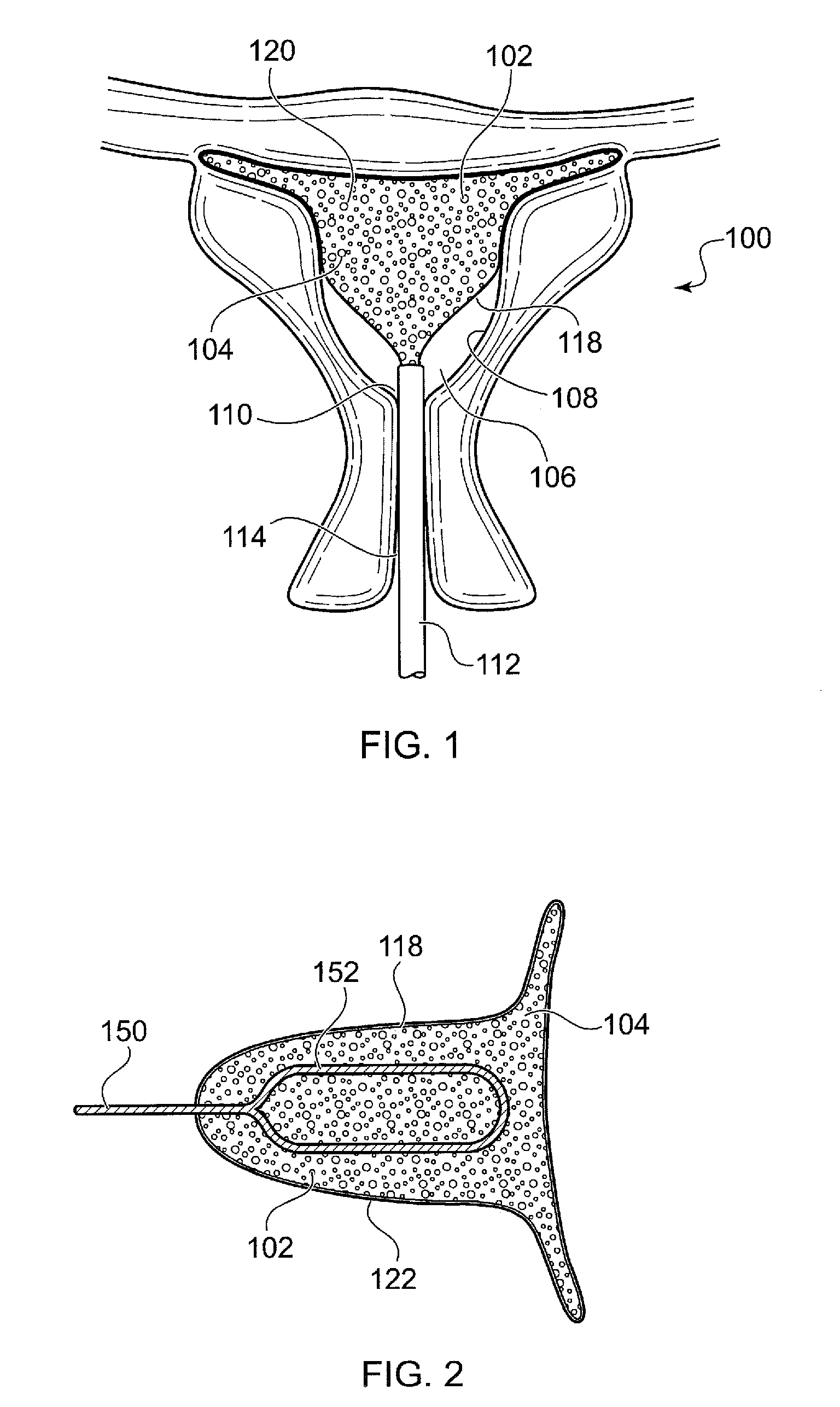 Uterine foam insert for ablation