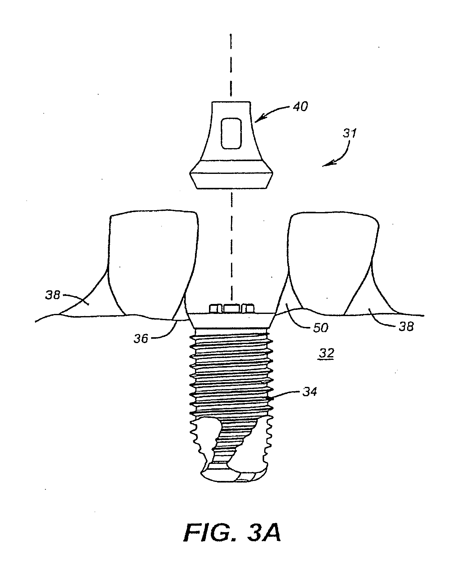 System for Immediately Placing a Non-Occlusive Dental Implant Prosthesis