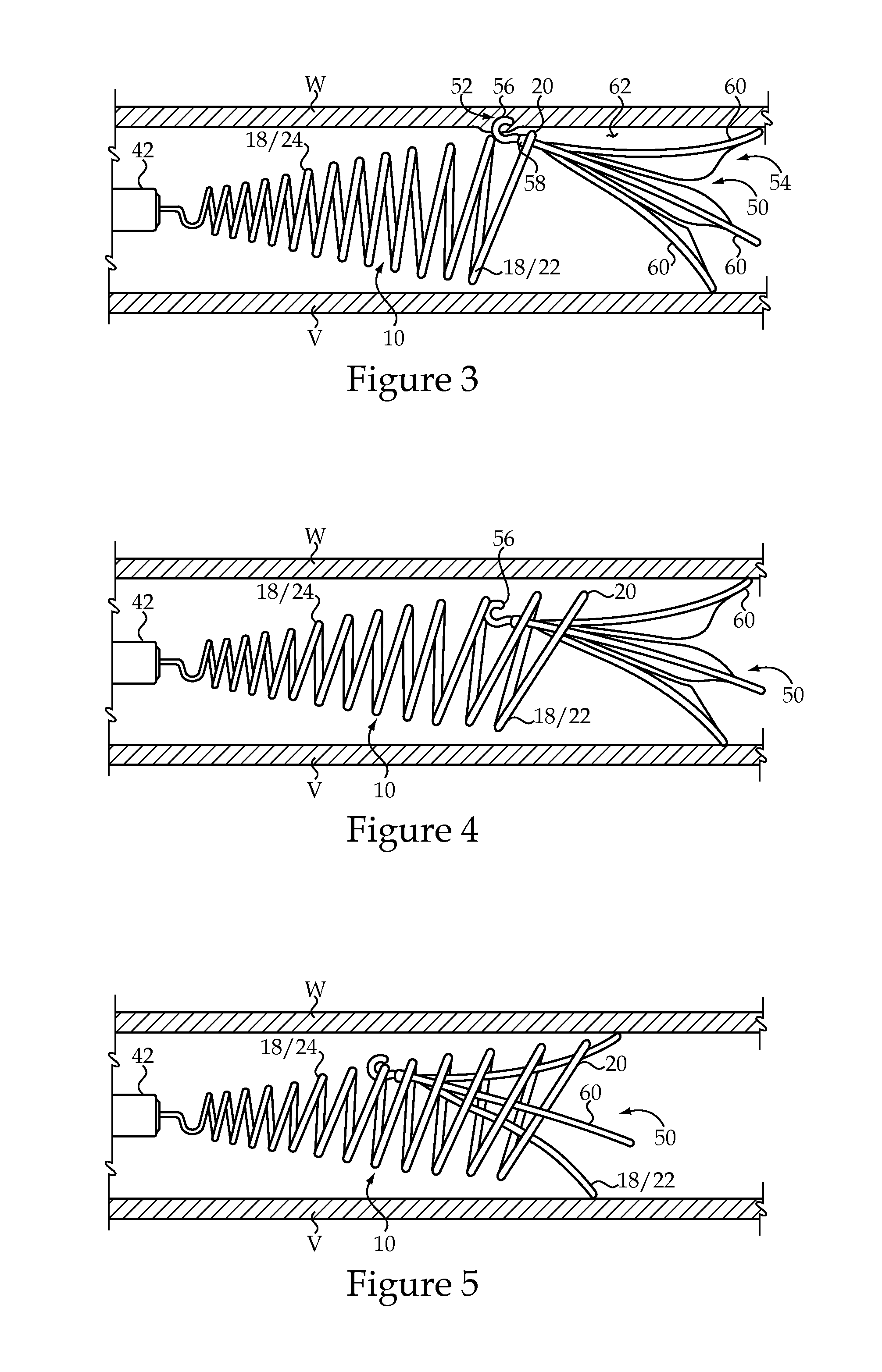 Vascular Implant Retrieval Method, Retrieval Assembly And Tool For Same