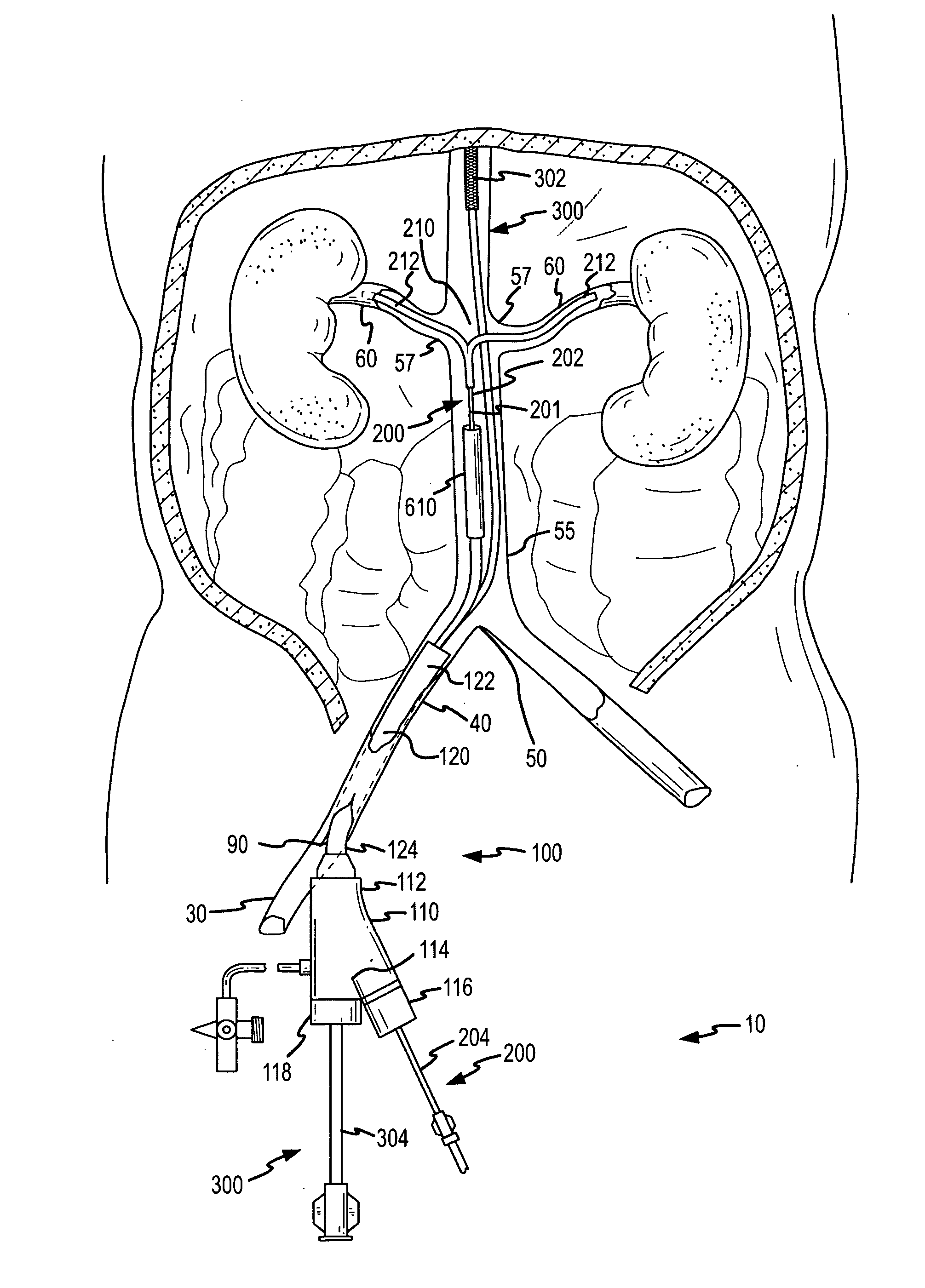 Renal infusion systems and methods