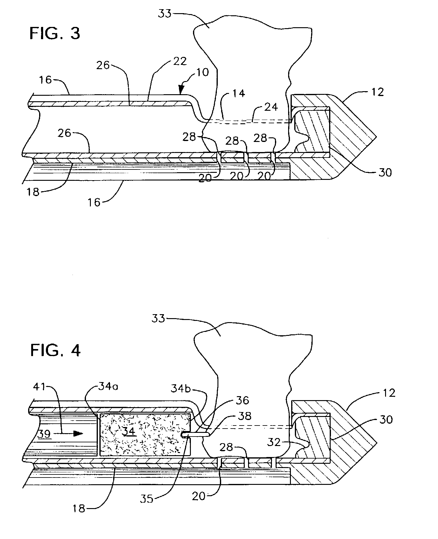 Bioabsorbable marker having external anchoring means