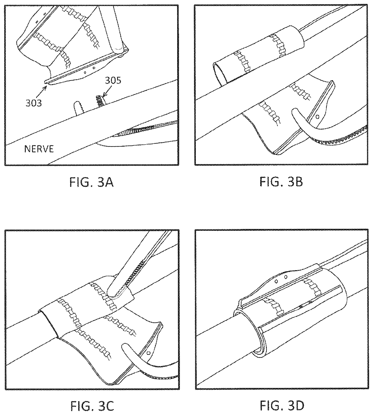 Nerve cuff deployment devices