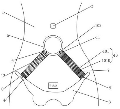 Single-port laparoscope fixing device for pneumoperitoneum-free operation