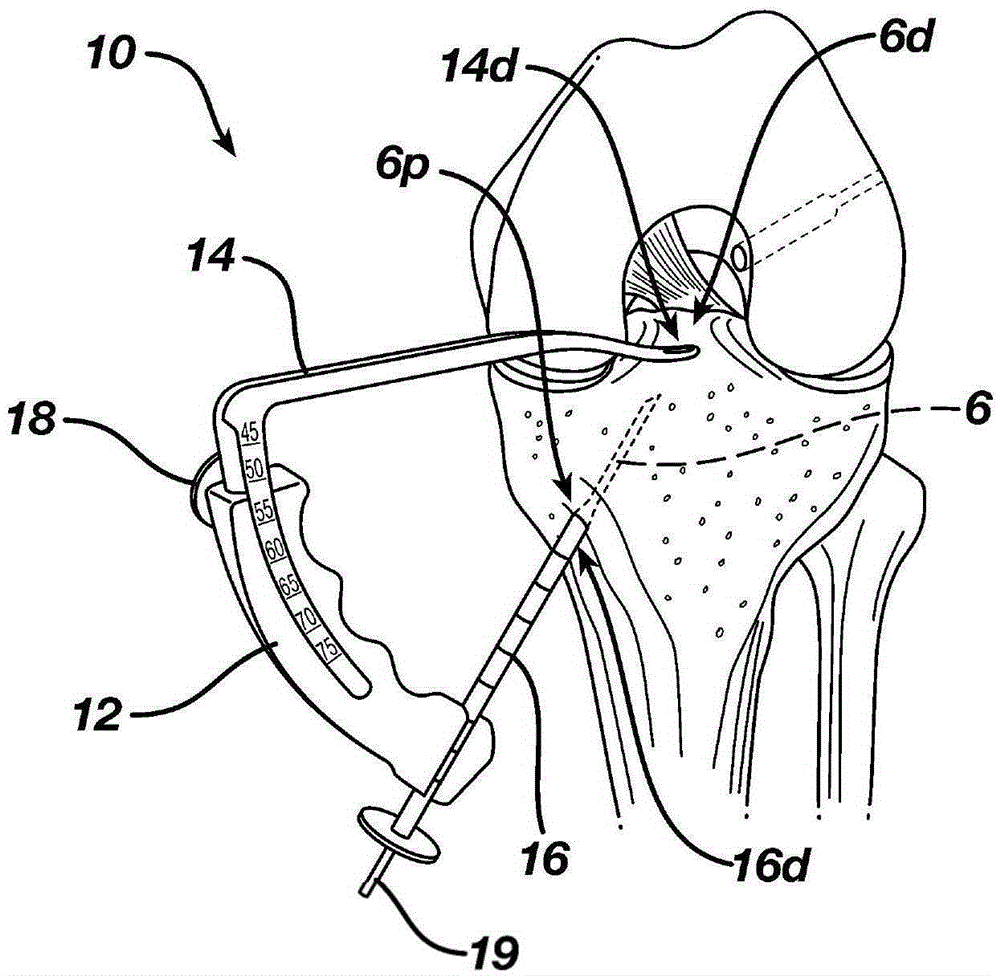 Gage for Limiting Distal Travel of Drill Pin