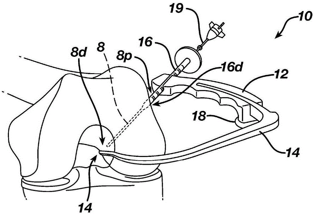 Gage for Limiting Distal Travel of Drill Pin