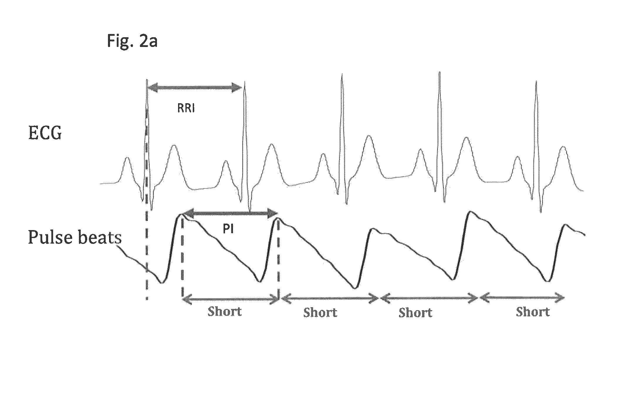 Detection and monitoring of atrial fibrillation