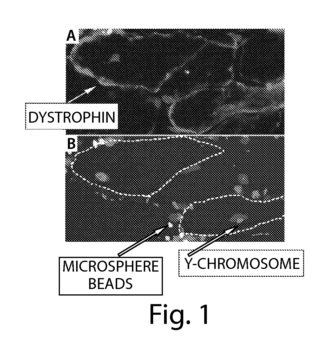 Skeletal muscle augmentation utilizing muscle-derived progenitor compositions, and treatments thereof