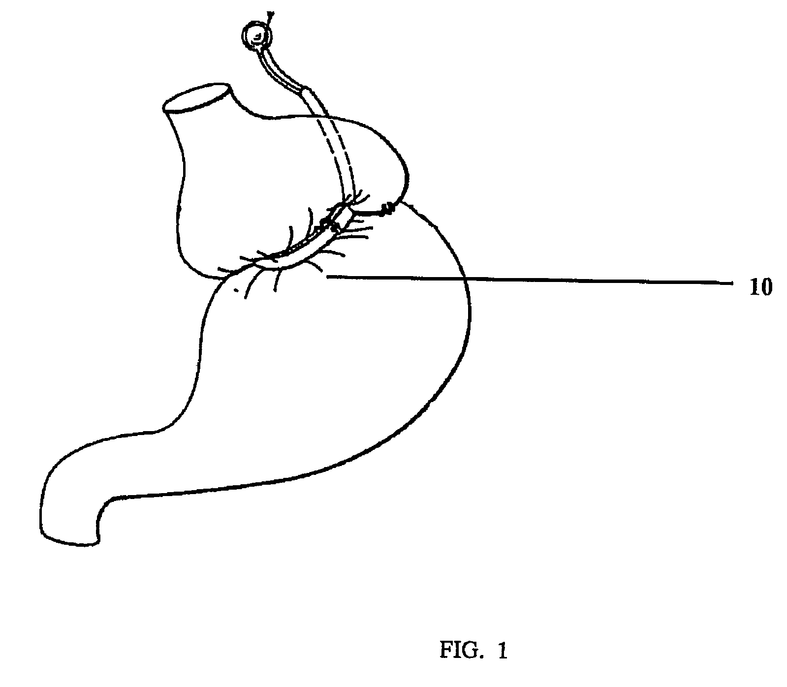 Gastric constriction device